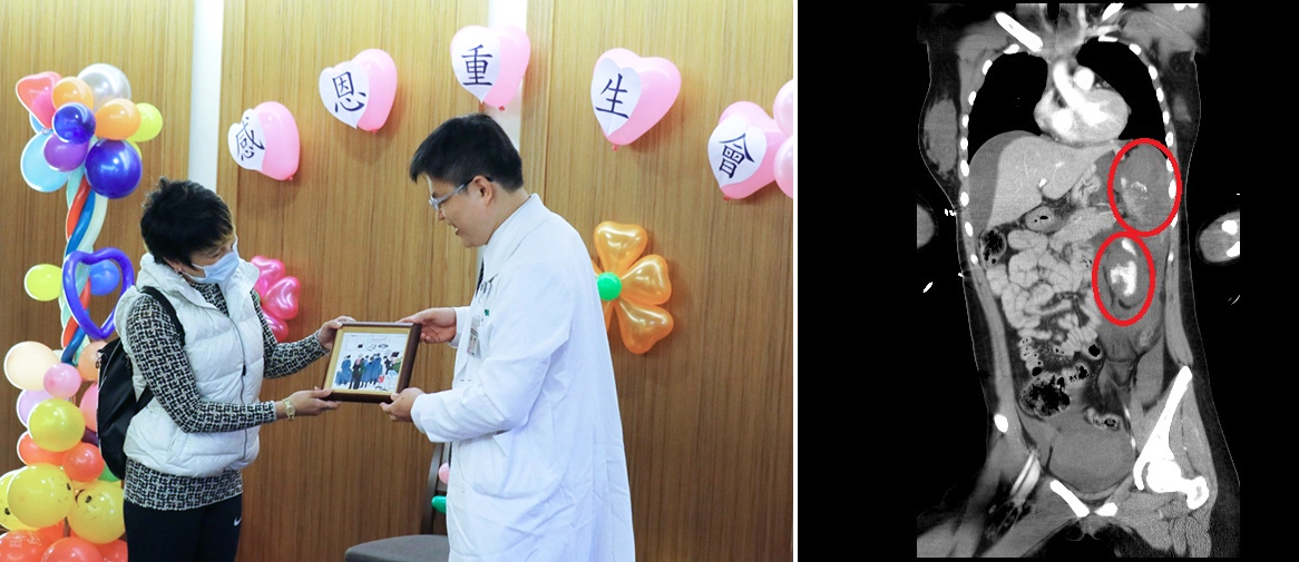 外科部主任余政展(右 )將葳葳的手術搶救圖送給媽媽,成為最特別的禮物。葳葳手術前的電腦斷層檢查,顯示脾臟(上)腎臟(下)嚴重受損。