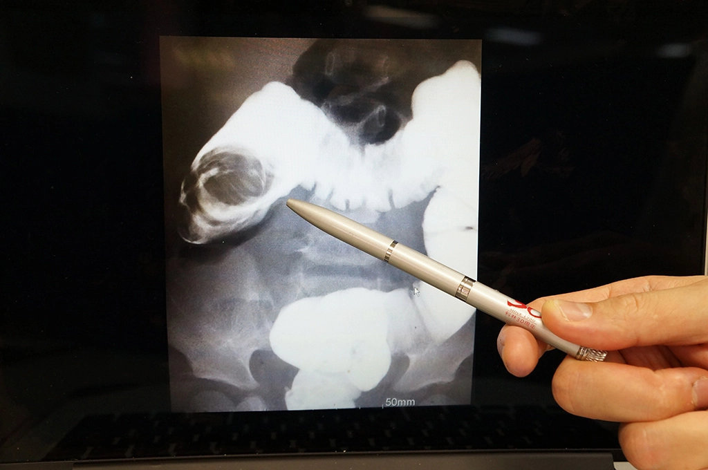 對於嬰幼兒腸套疊,為一種常見且父母及醫師都忽視不得的嬰幼兒腹部急症,由於不一定會出現典型症狀,加上孩子不會表達,因此在鑑別診斷上仍有一定難度。