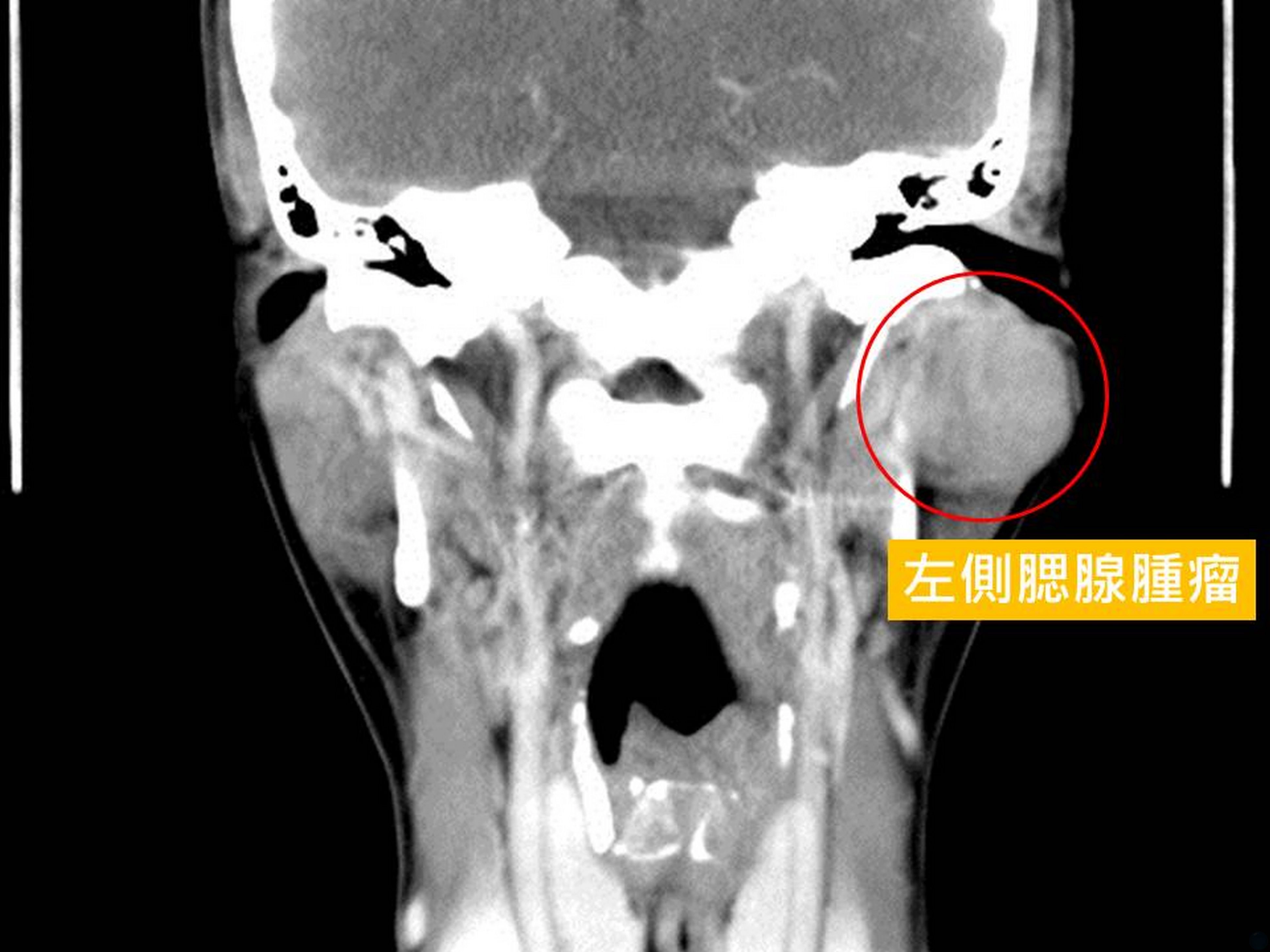 電腦斷層顯示腮腺腫瘤近4公分,像個包餡湯圓。