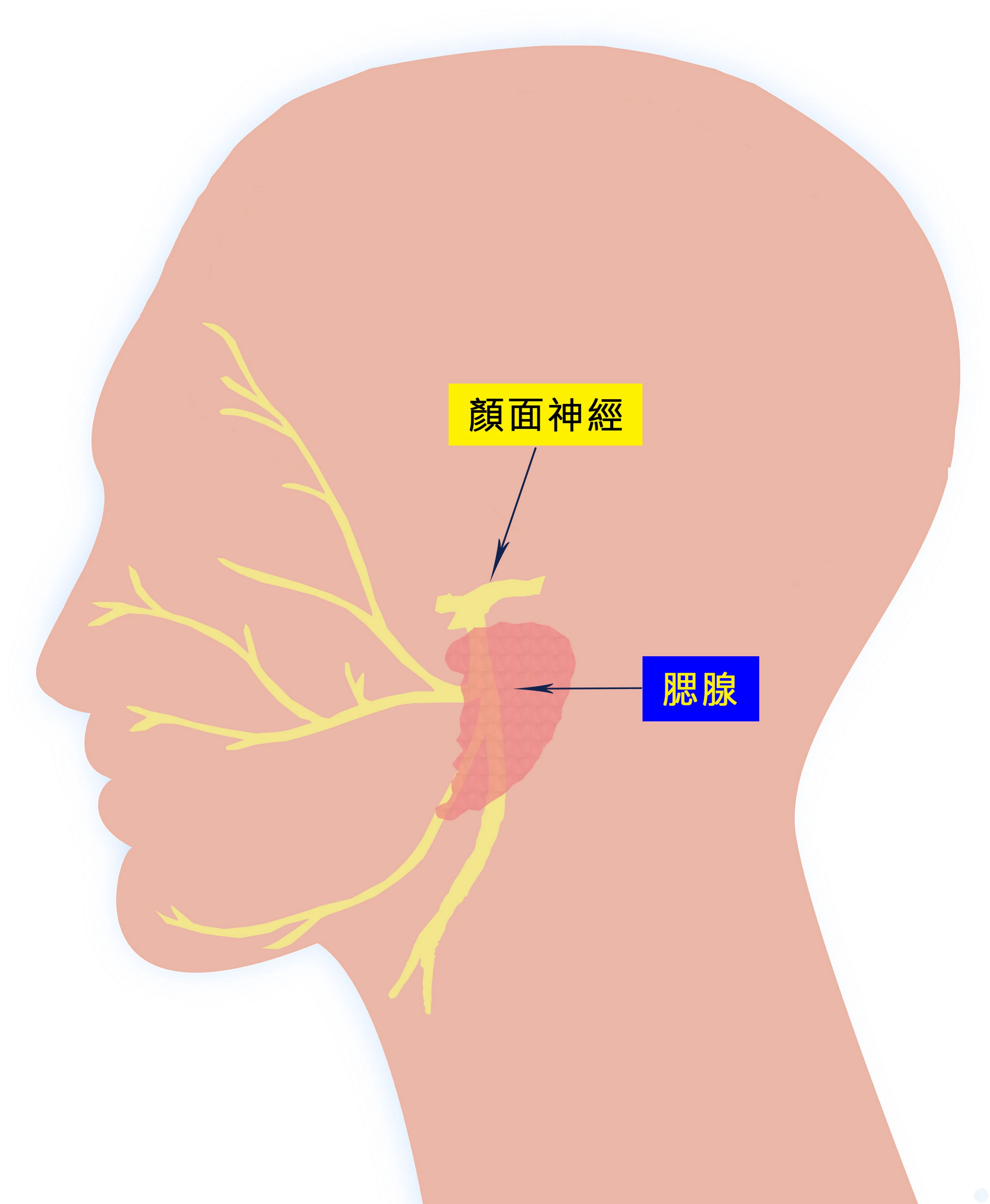 腮腺與顏面神經很接近,若拖延不處理導致腫瘤愈變愈大,會增加手術困難度與顏面神經損傷機率。