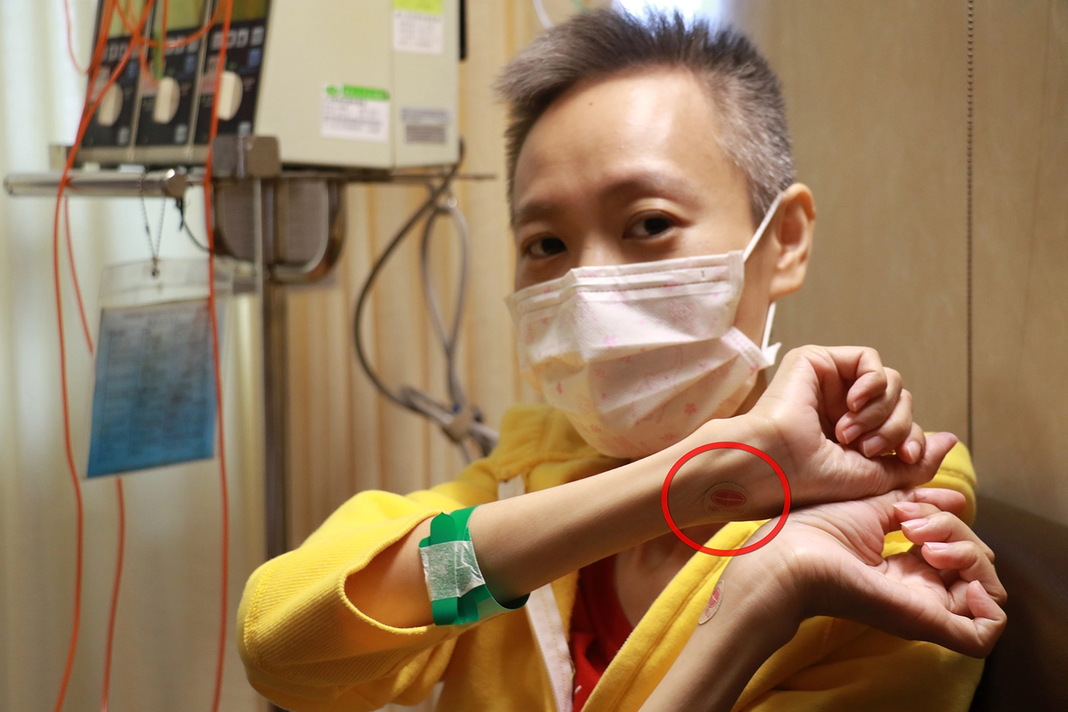 陳小姐以磁力貼加強內關穴刺激(紅圈)。