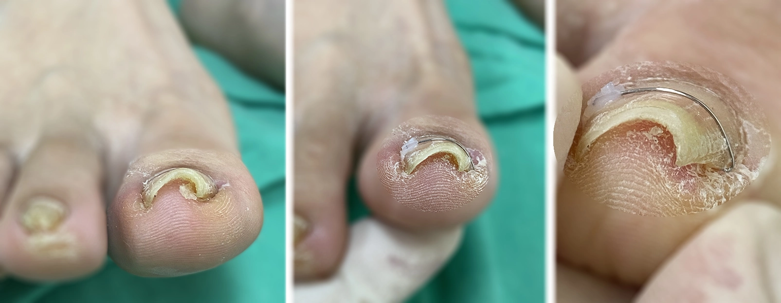 俗稱「凍甲」的嵌甲症,利用矯正器進行指甲矯正,不用開刀馬上就解決了