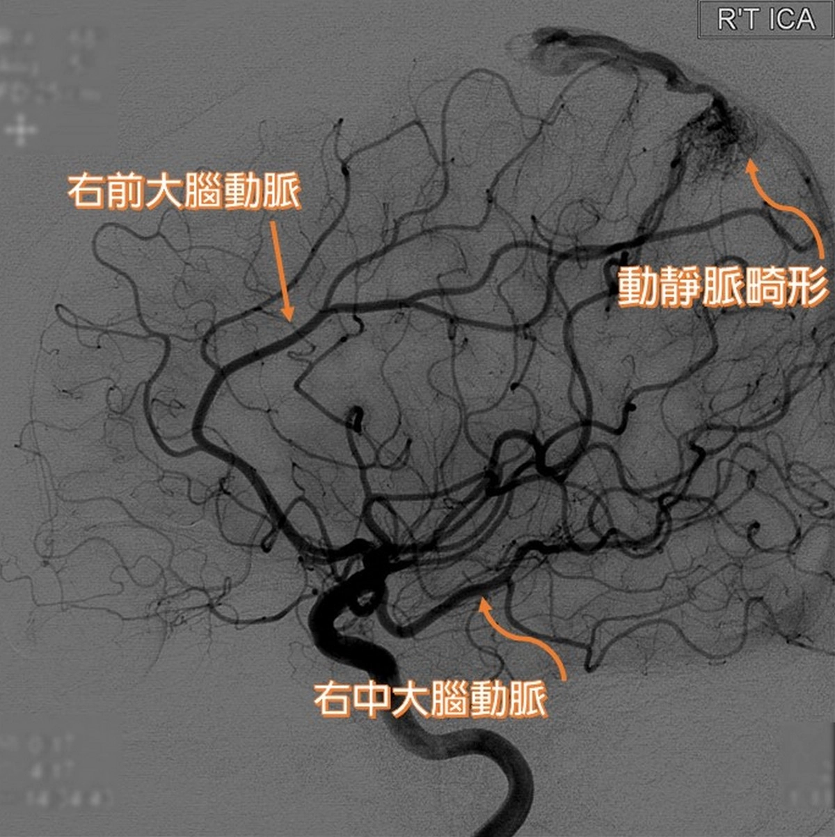 動脈畸形患者因腦內微血管發育不全,腦部動、靜脈交會處有不正常的畸形組織,使動脈直接注入靜脈。