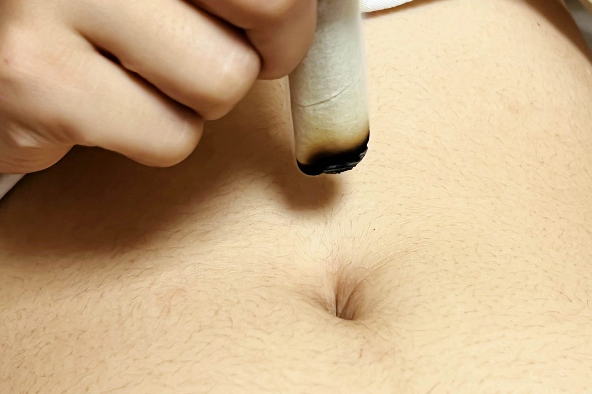 艾灸肚臍周圍特定穴位,配合醫師治療,溫女士病情控制穩定。圖為艾灸示意照。