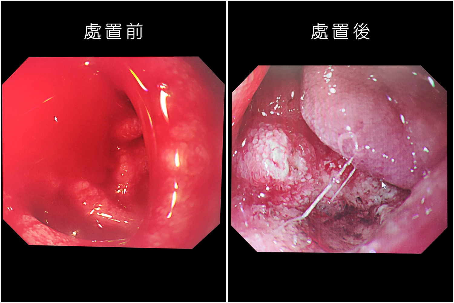 上消化道出血內視鏡治療前後。(賴廷翰攝)