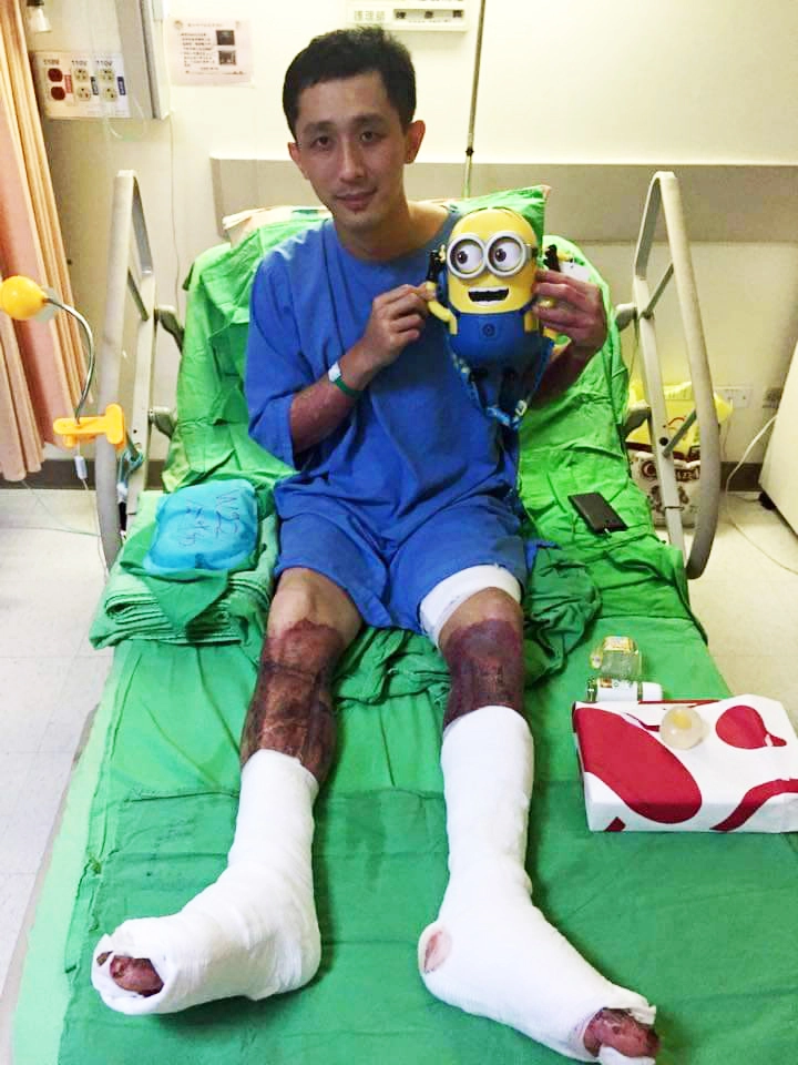 曾是八仙塵爆傷者之一,蔡豐燦四肢特別是雙腿有大面積嚴重燒燙傷,在歷經長達兩個多月的植皮治療過程,「打針」對他曾是一大夢魘。