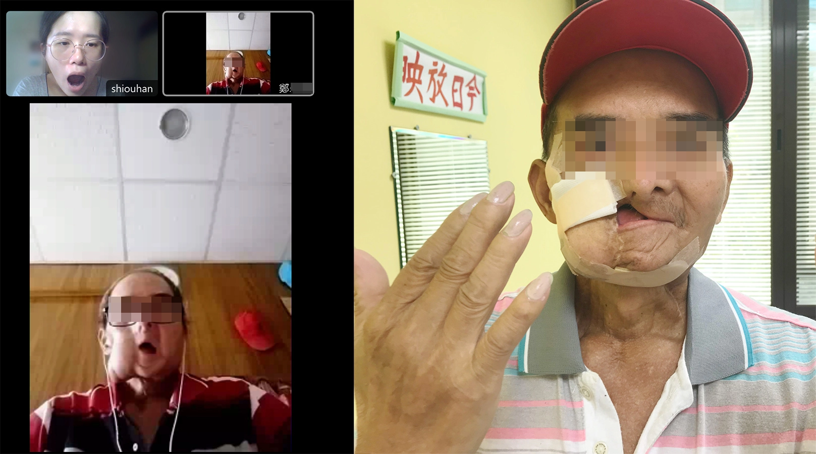 疫情期間陽光基金會治療師持續視訊復健 助鄭大哥為皮瓣重建手術準備