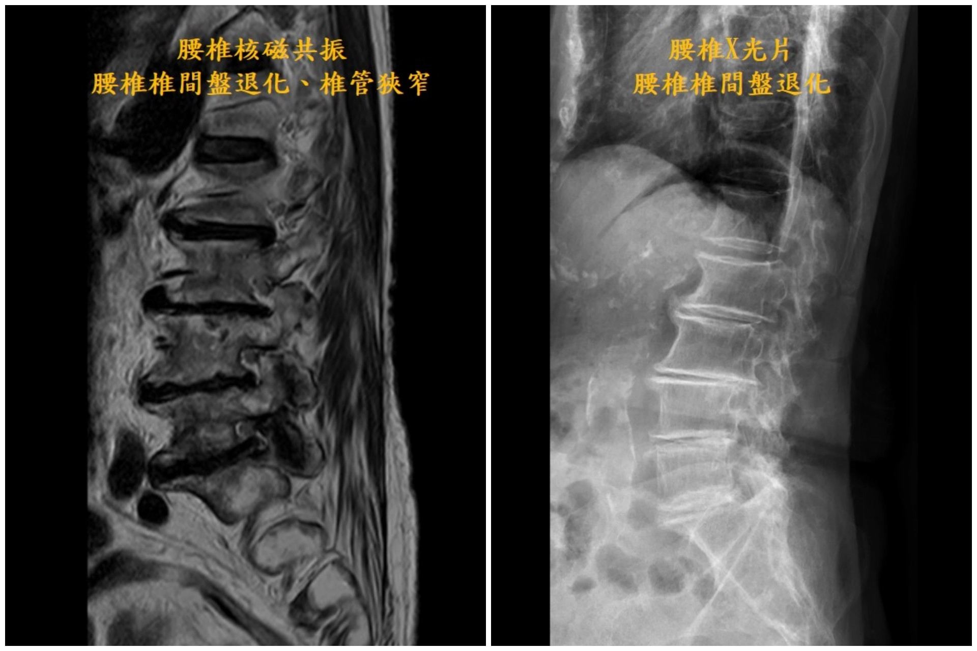(左圖)腰椎椎間盤退化及椎管狹窄。(右圖)腰椎椎間盤退化