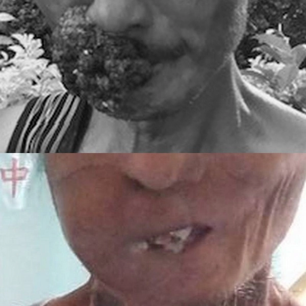 呂先生的惡性腫瘤擴及顏面及嘴唇(上);魏林瑰醫師藉由「顯微游離皮瓣移植」為病人重建。
