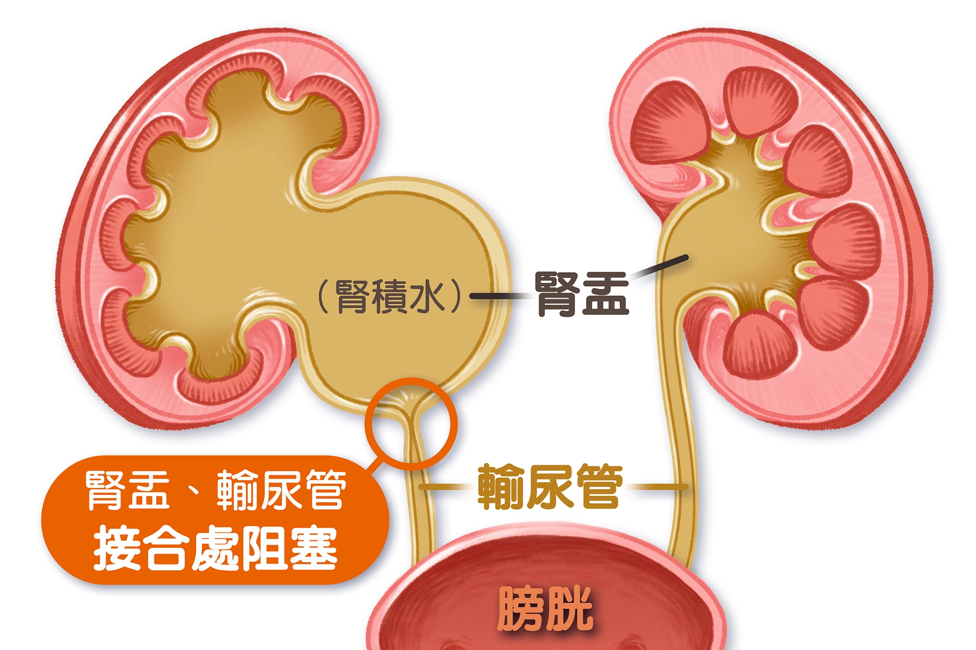 「腎盂輸尿管接合處狹窄」 導致腎水腫示意圖。