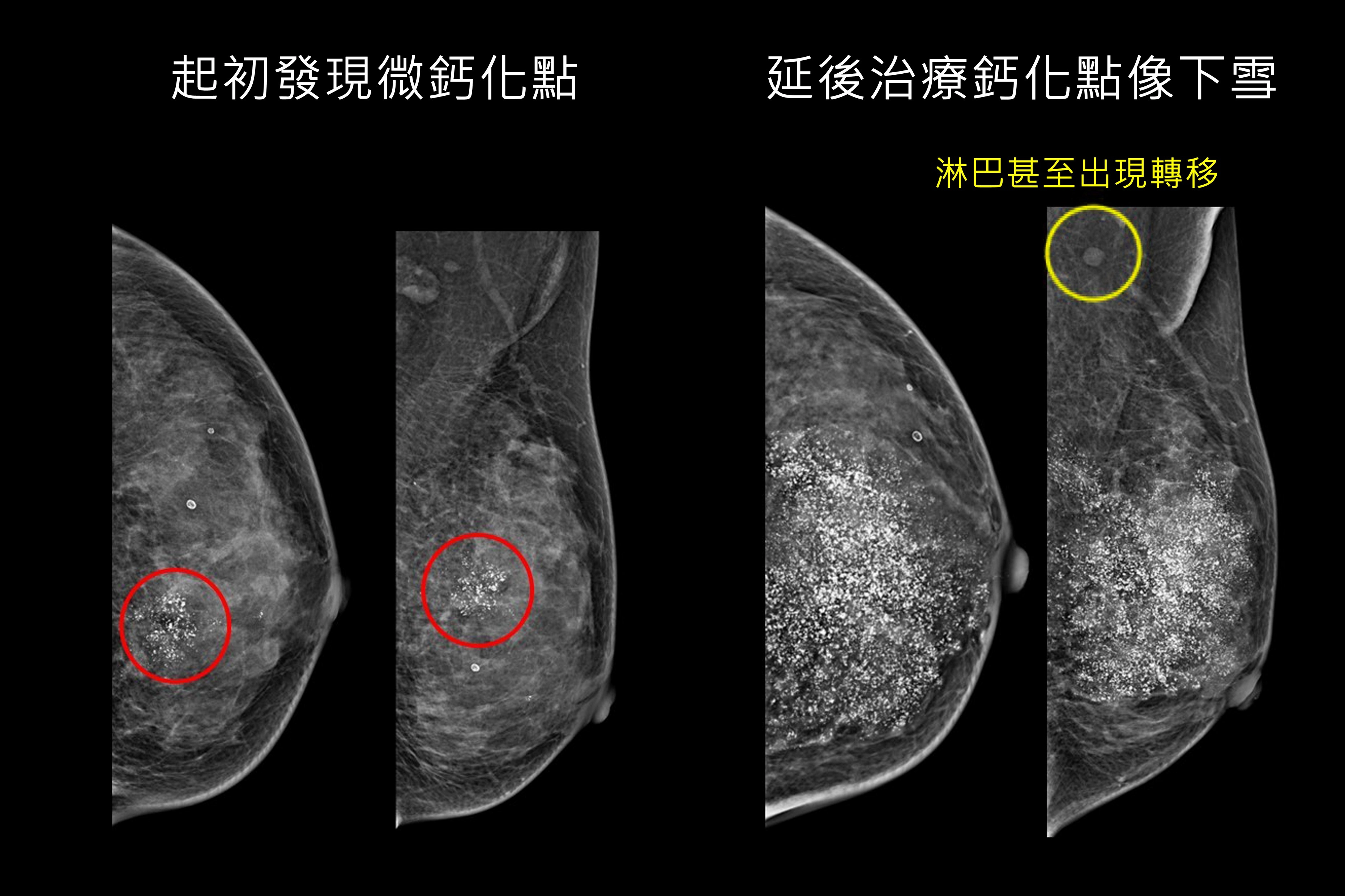 婦人接受乳房攝影篩檢發現微鈣化點,再切片確認罹患早期乳癌(左圖 ),延後治療再檢查,鈣化點如下雪並已出現淋巴轉移(右圖 )