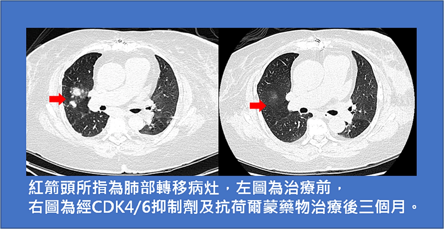 台東馬偕蔡承志醫師表示末期乳癌仍可靠新型標靶藥物獲控制。