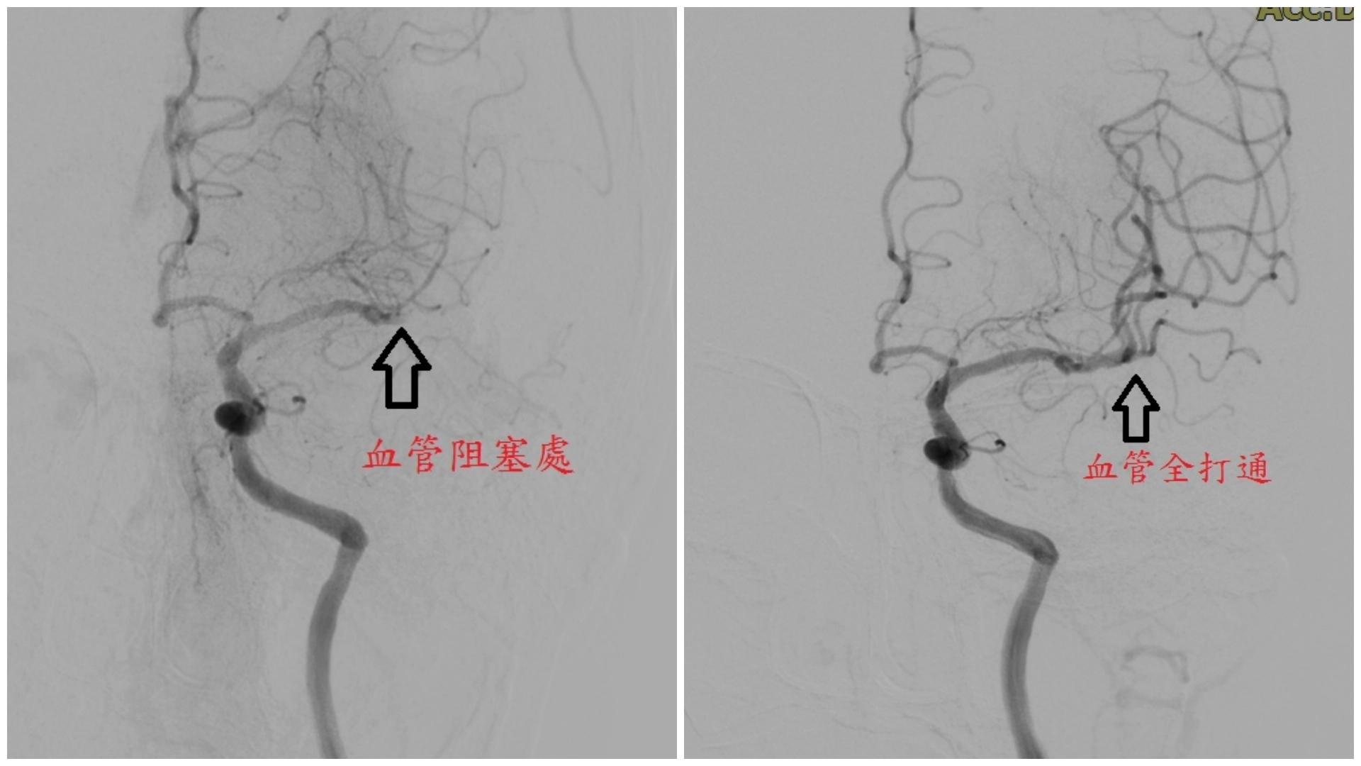 (左圖)取栓前(右圖)取栓後