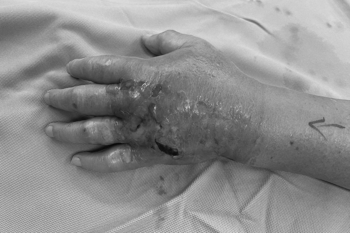 吳先生因被魚刺刺傷造成壞死筋膜炎,手掌呈現腫脹。
