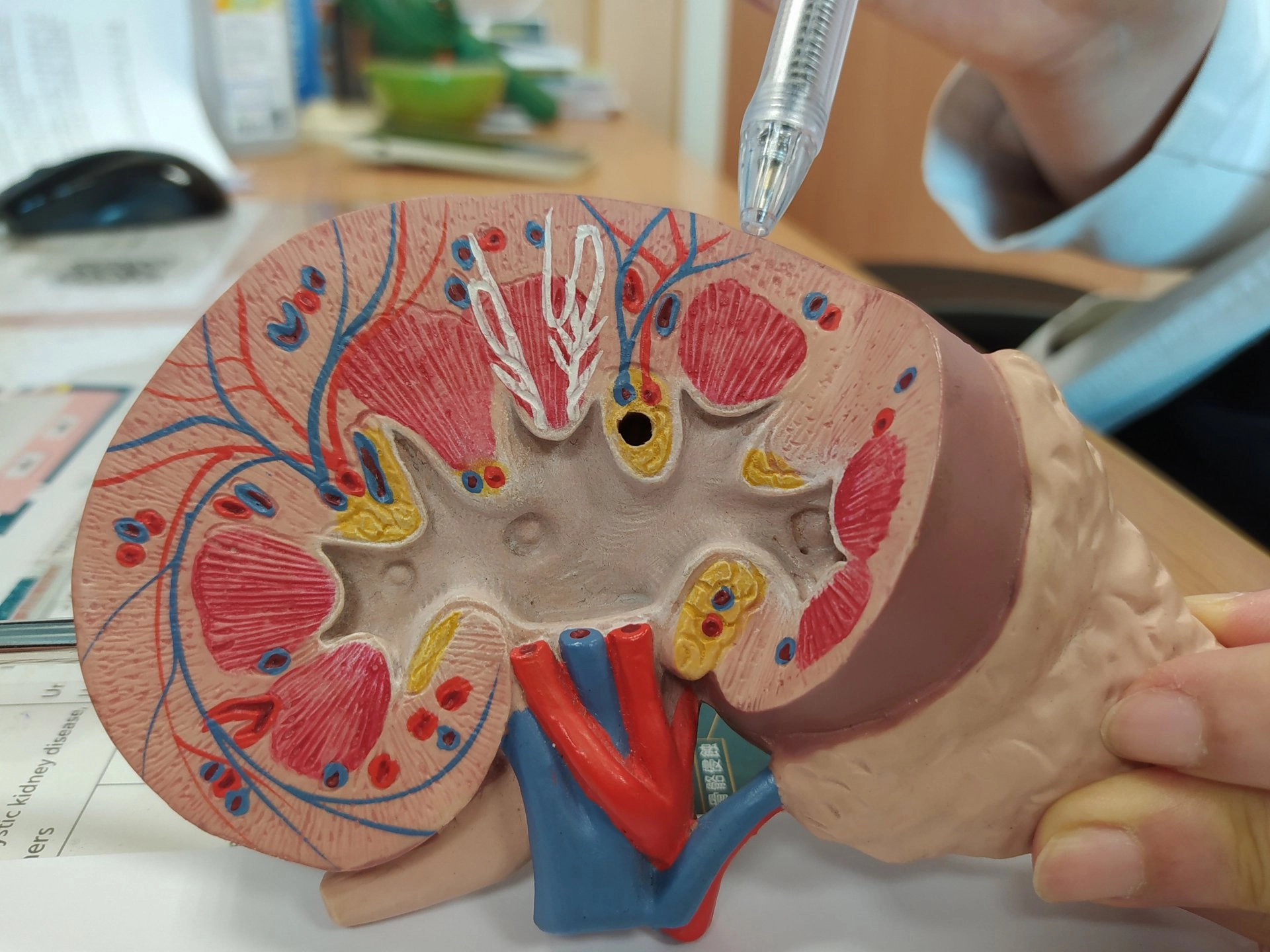 婦人經腎臟切片檢查,確認罹患紅斑性狼瘡性腎炎。
