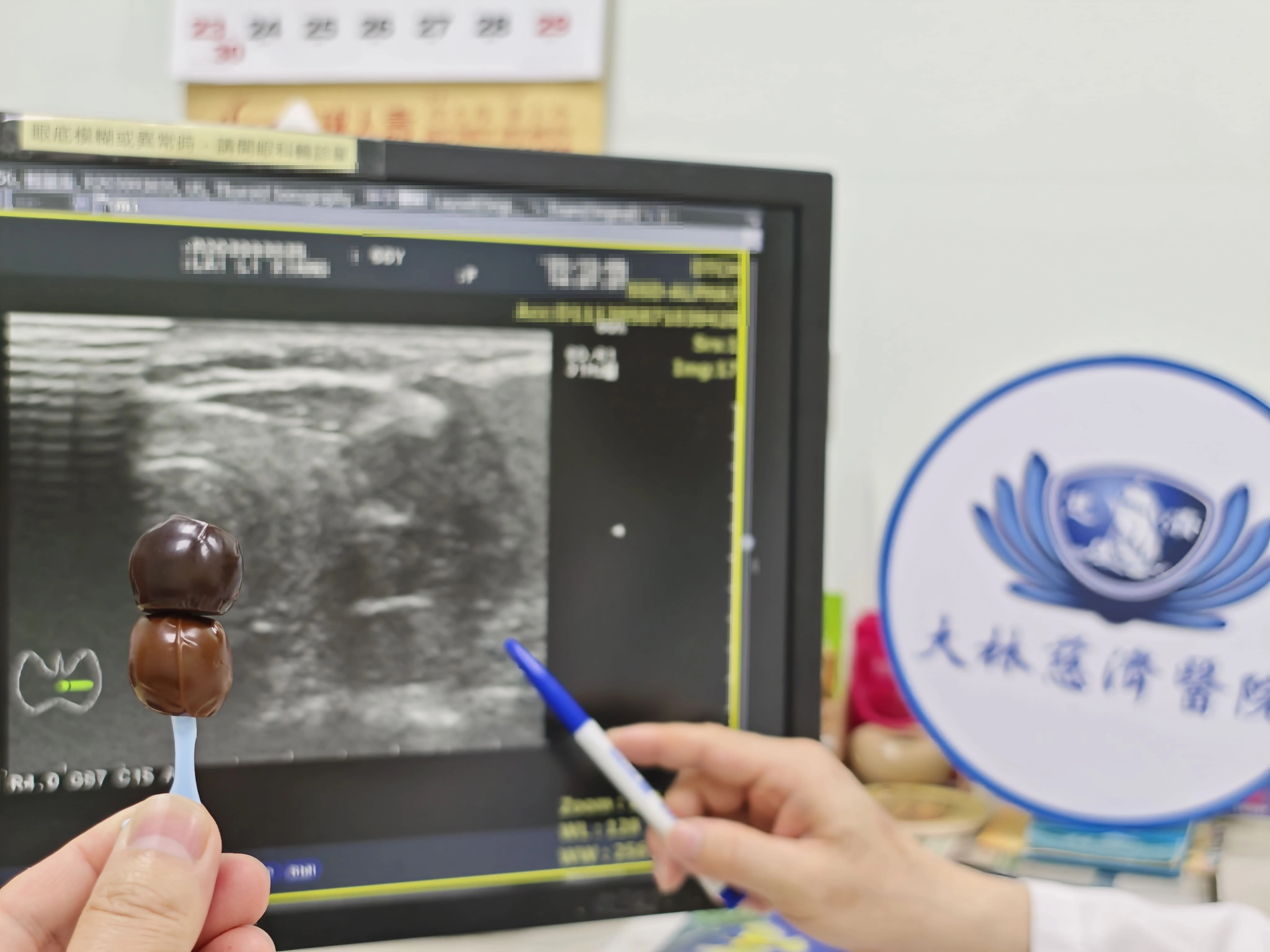 廖唐毅醫師手指甲狀腺癌3.3公分，如2粒大小鐵蛋。