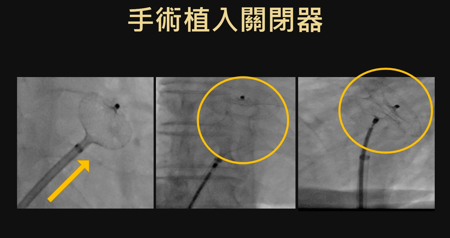 手術時將心房中膈缺損關閉器植入,在缺損的位置將關閉器展開,並將缺損修補。