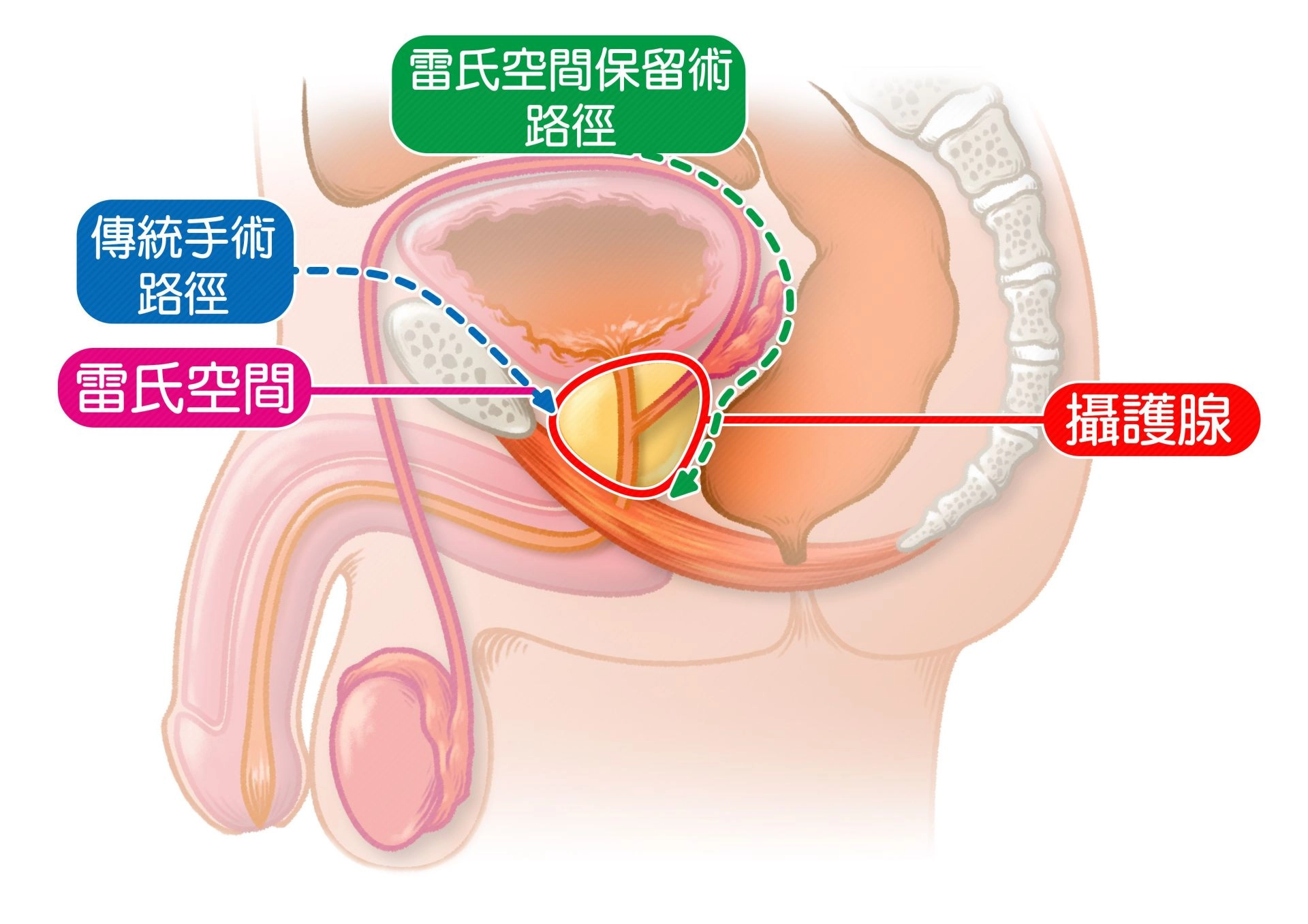 雷氏空間保留術(綠色)改善攝護腺切除手術後漏尿與性功能障礙問題,提升病人生活品質。