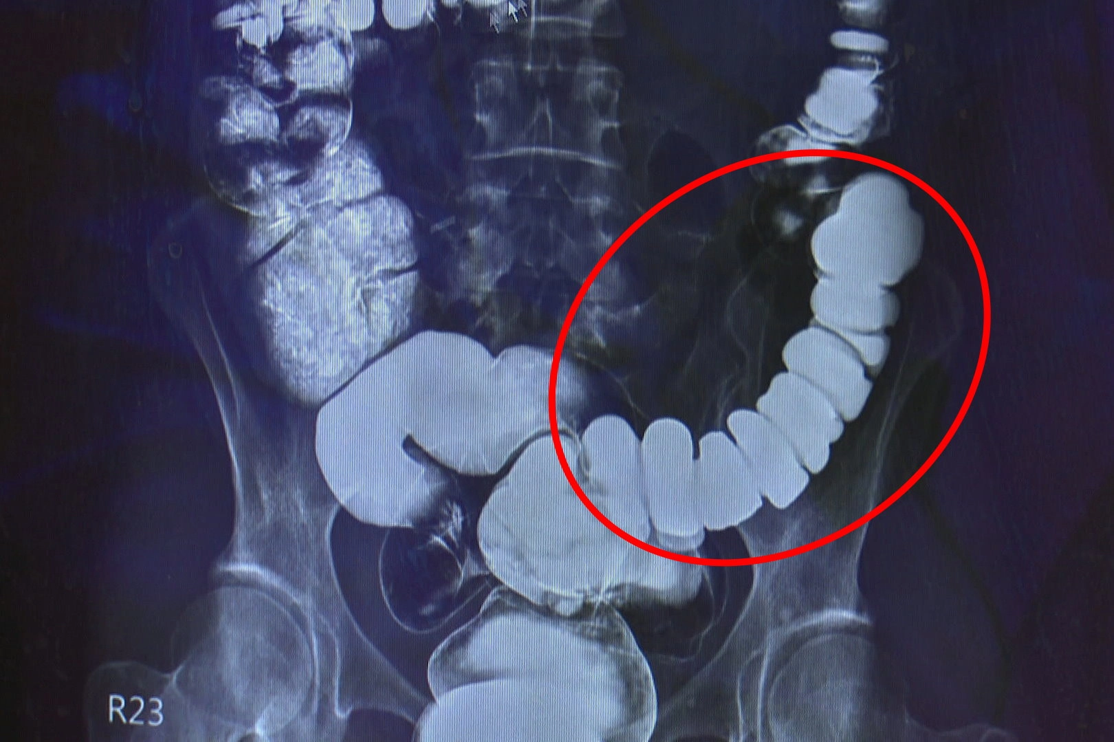 邱建銘主任從大腸攝影檢查發現,江小姐腸子繃得非常緊。