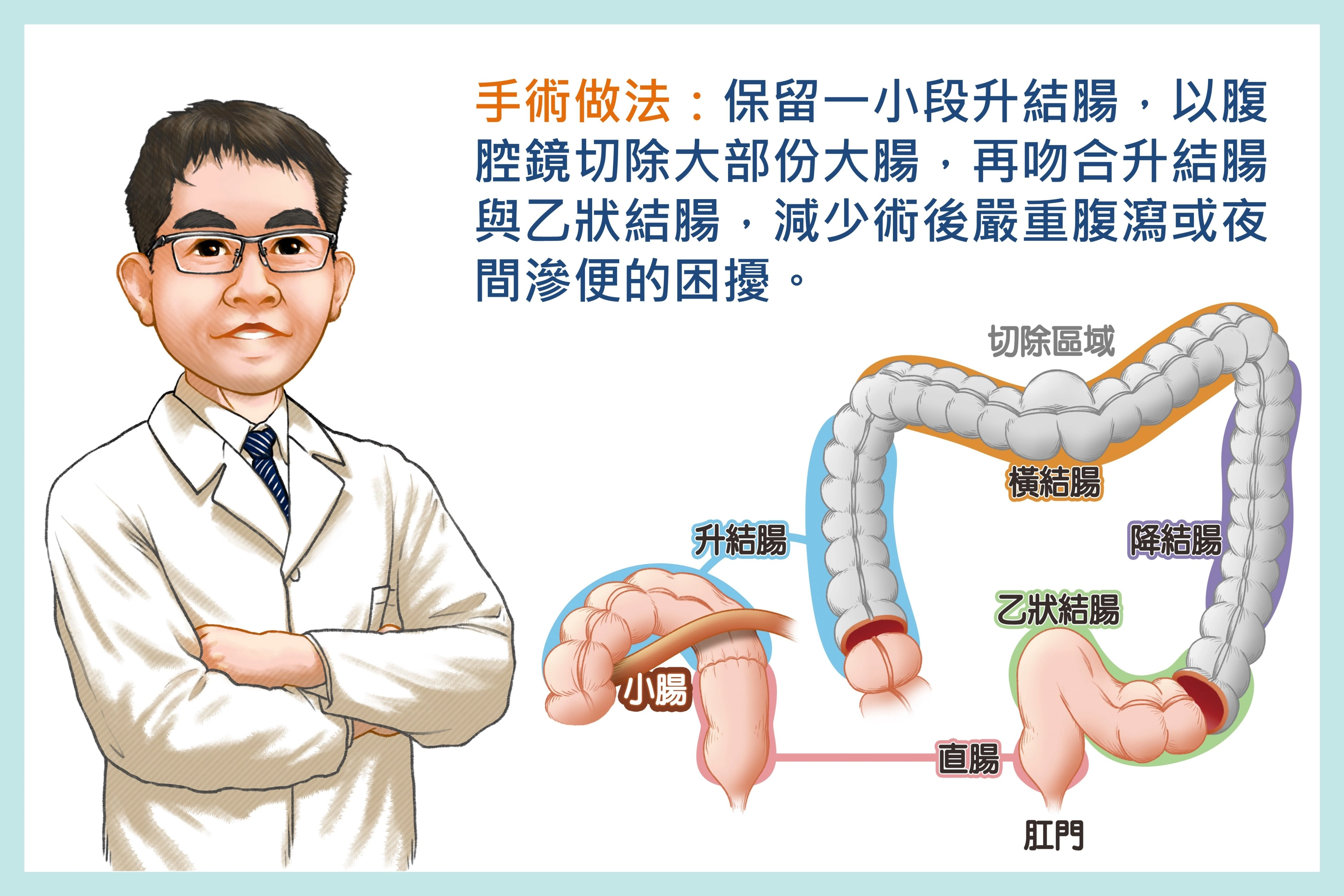 邱建銘主任保留病人一小段升結腸,切除大部份大腸,再吻合升結腸與乙狀結腸。