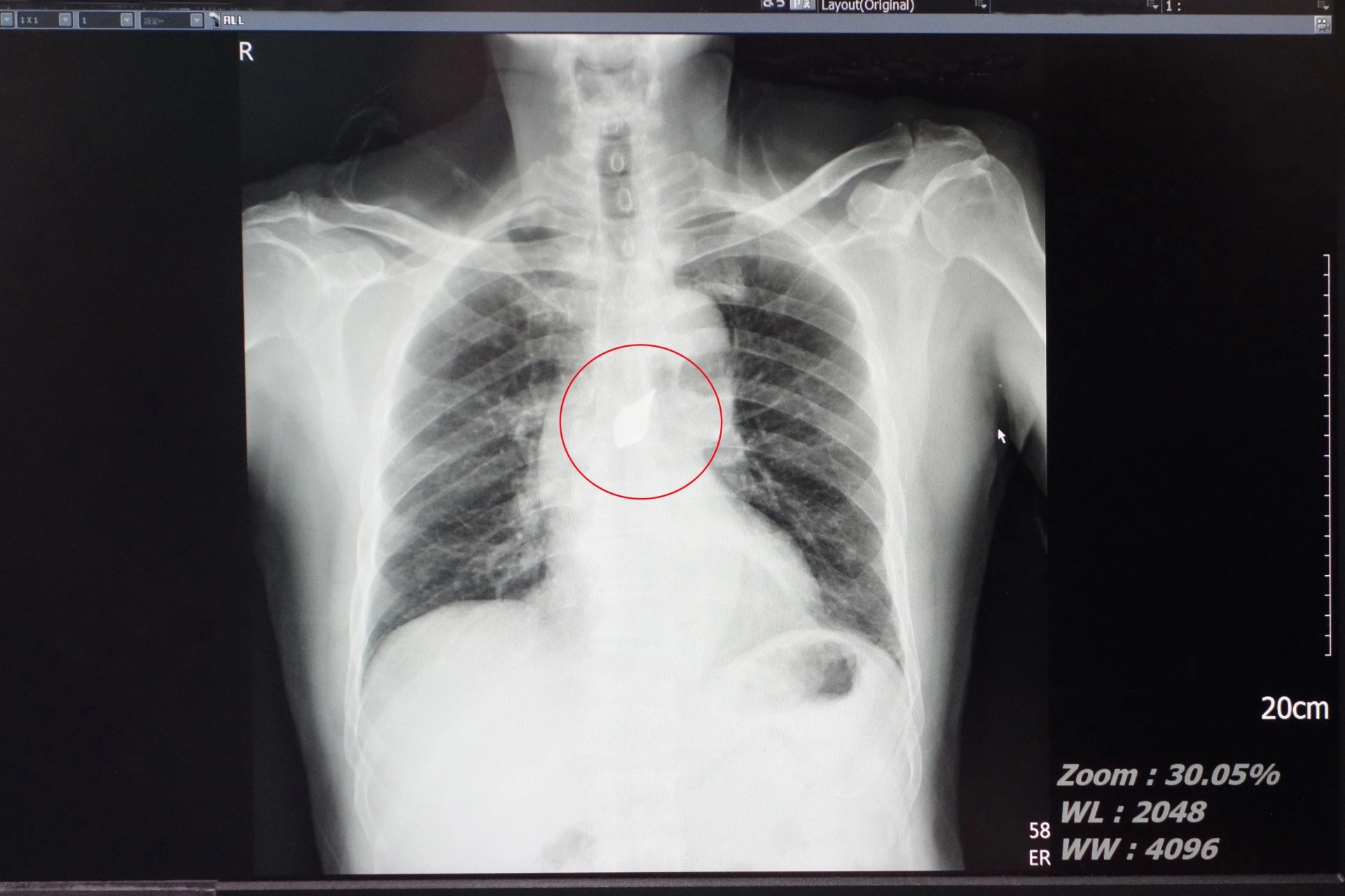 補充:病人左胸傷口,但是碎片在體內移動到中央偏右處。所以胸腔鏡是做右邊