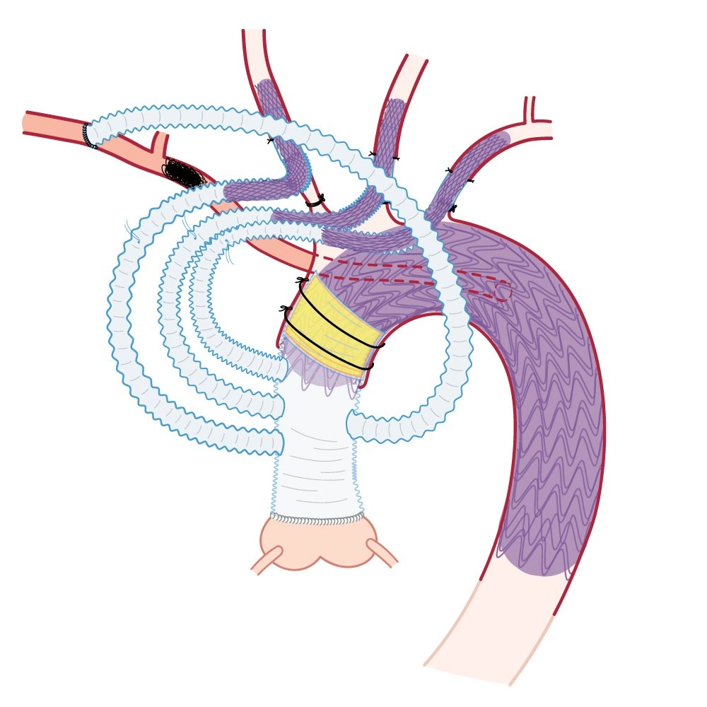 《大林術式》(Dalin procedure)