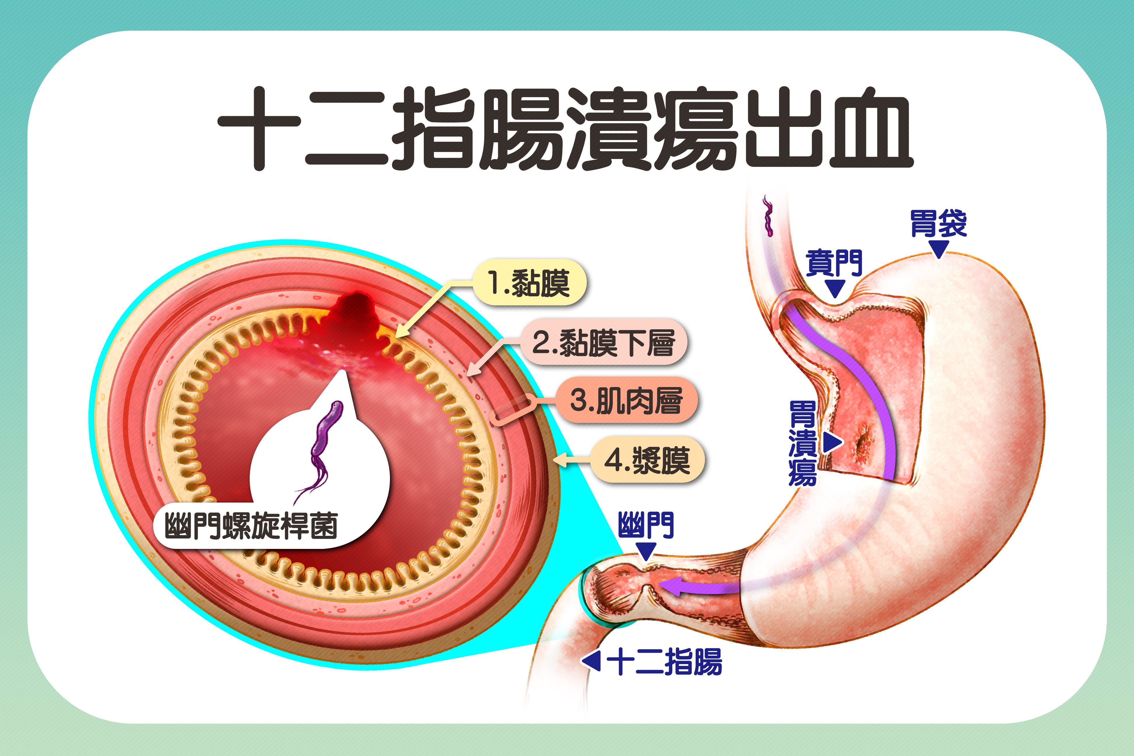 幽門螺旋桿菌經由糞、口傳播，能生存在酸性環境引發黏膜發炎、潰瘍，進而導致癌症。