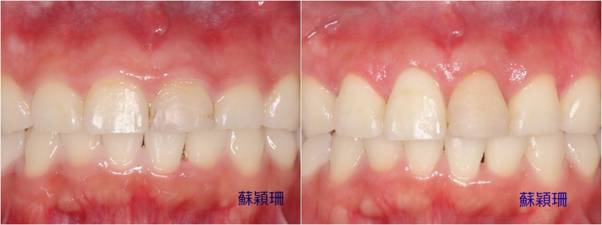 病人因為變異被動性萌發導致牙冠過短(左);經過牙冠增長術提升美觀與自信(右)。