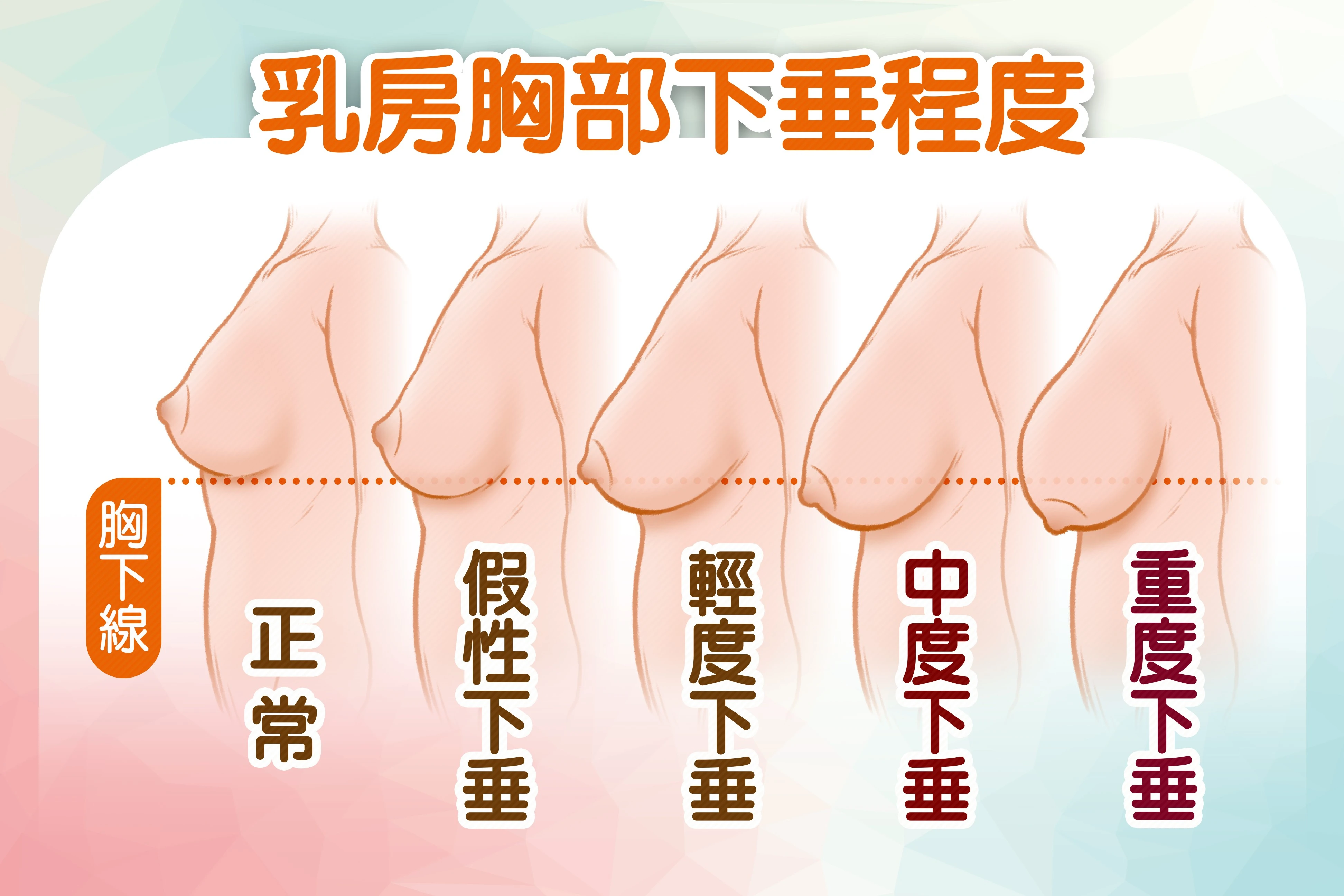 女性乳房下垂程度,可以藉由乳頭或乳暈相對於乳房下緣線的位置,來判斷下垂程度。
