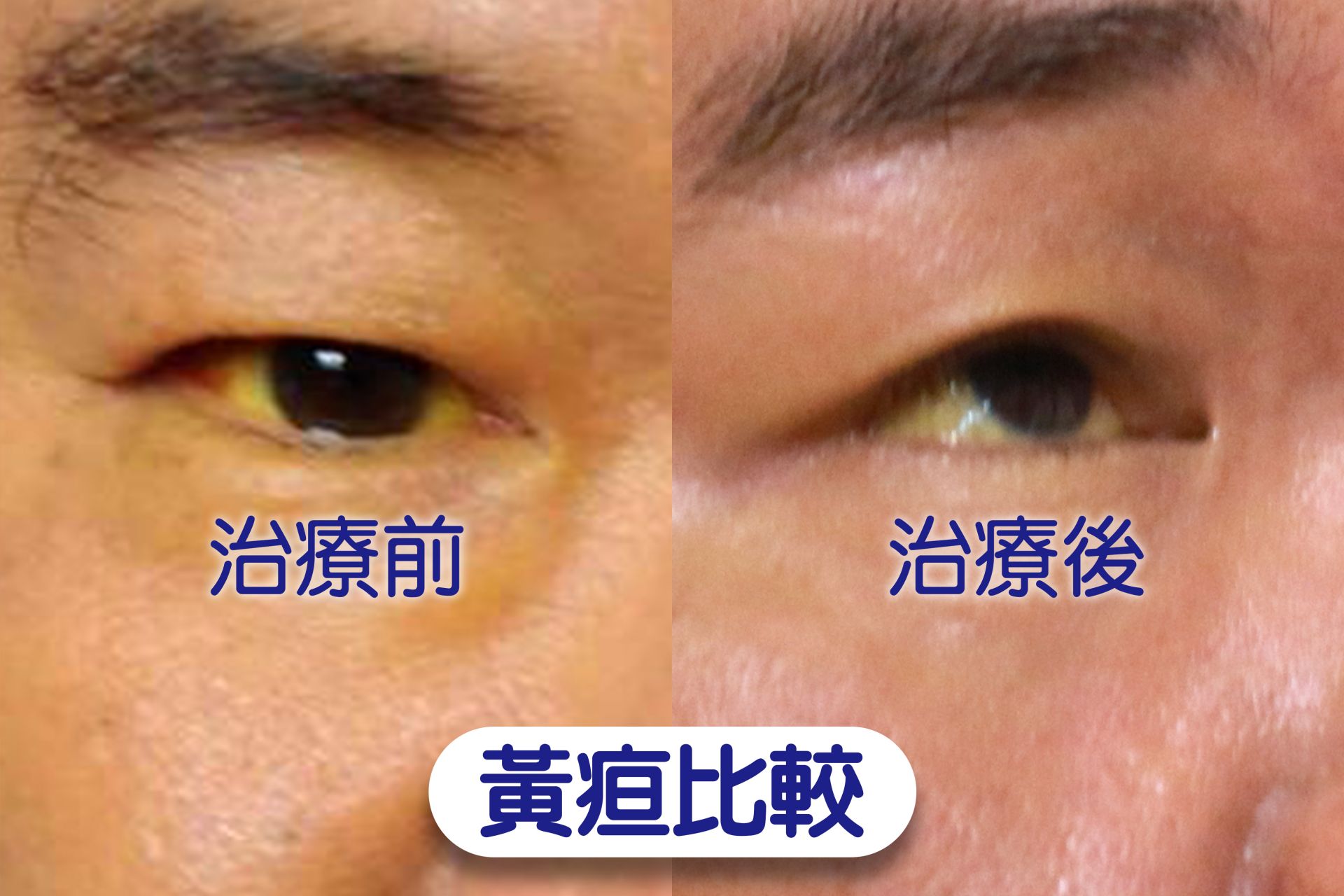 林先生治療接近兩周,黃疸症狀逐漸消退,但眼白依然看得到黃色。