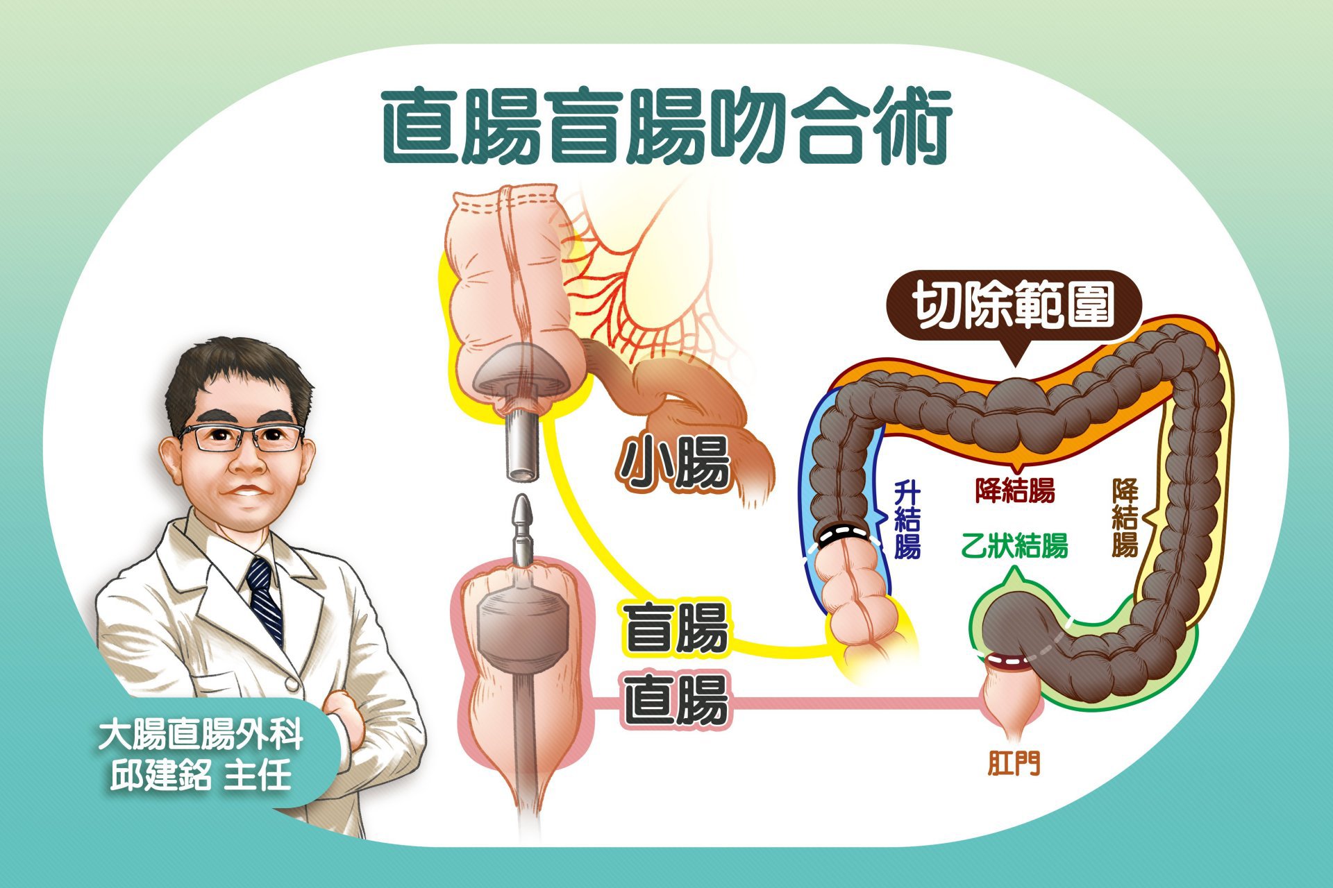 邱建銘主任為病人切除已失去功能的大腸,並將盲腸與直腸吻合,以預防術後過度腹瀉或夜間滲便。