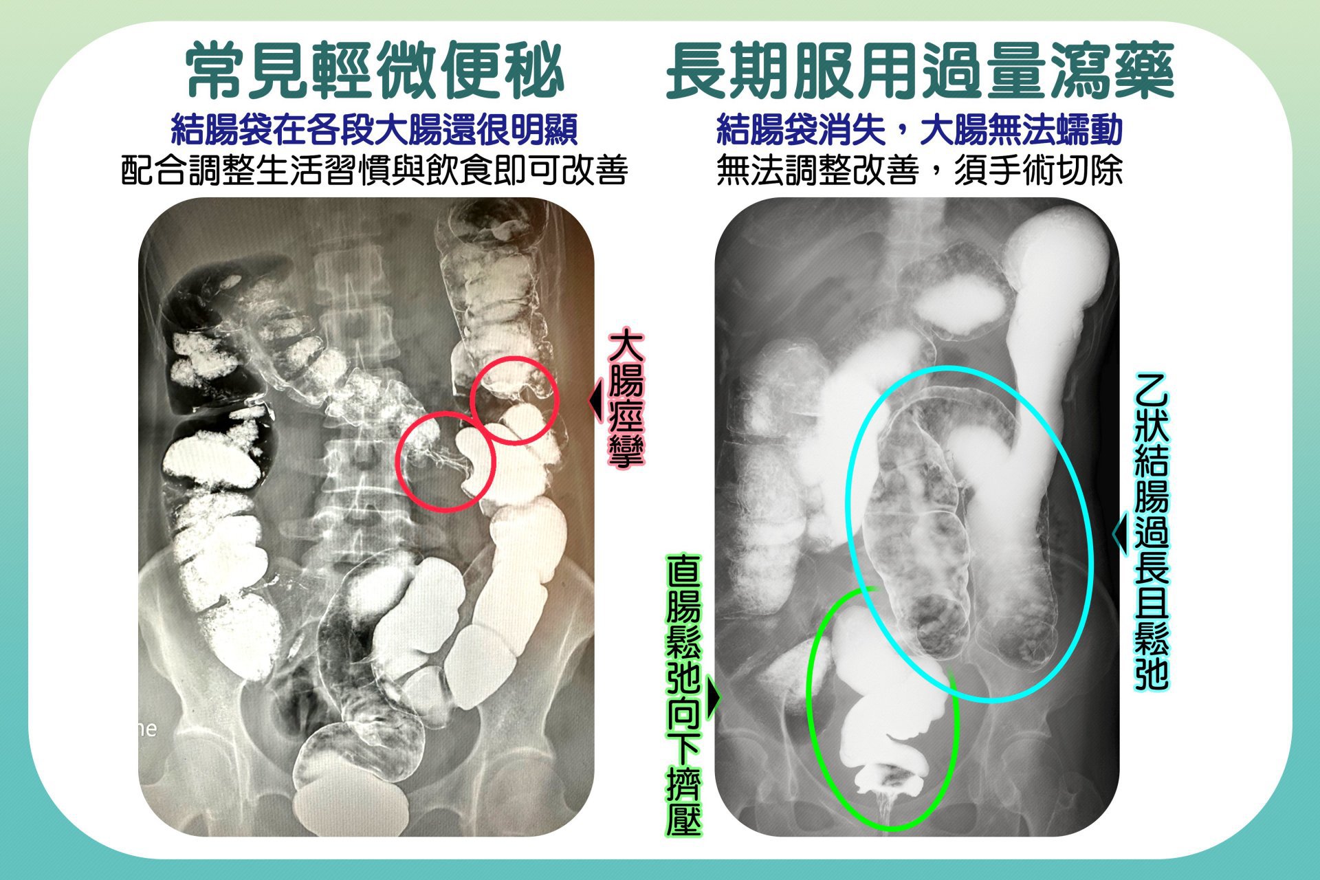 :左圖顯示輕微便秘的腸道狀況,大腸蠕動正常,調整生活習慣及飲食即可改善;右圖為長期過量服用瀉藥的腸道變化,結腸袋消失,無法蠕動,須靠手術解決。