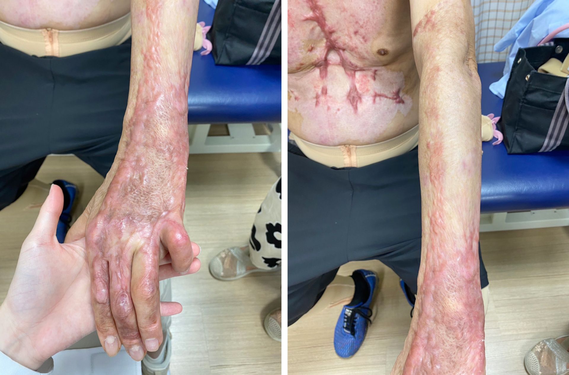 李先生因瓦斯氣爆致全身由頭到腳,百分之50面積二至三度燒傷