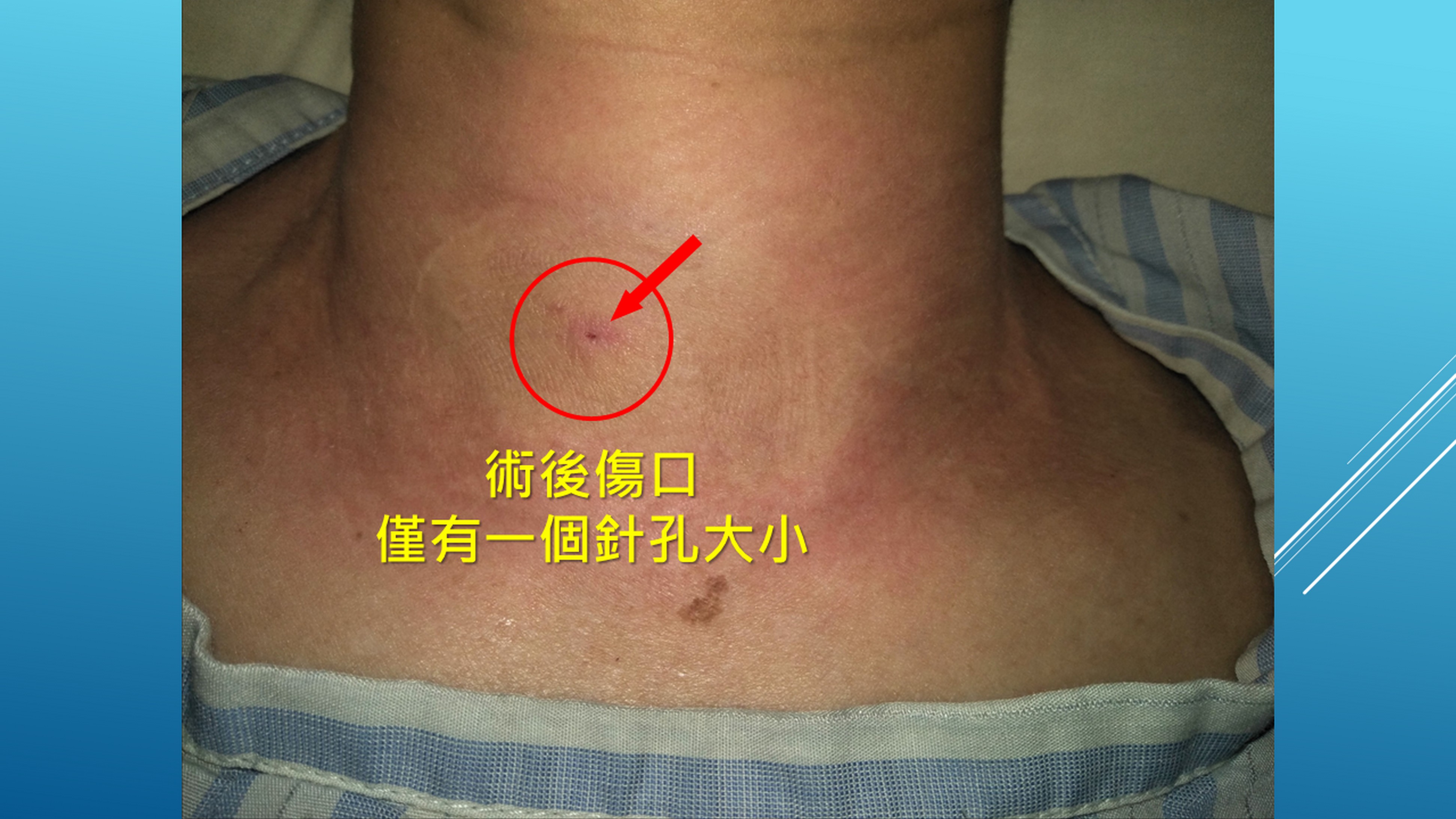 「頭頸腫瘤消融術」術後傷口只有一個針孔大小。