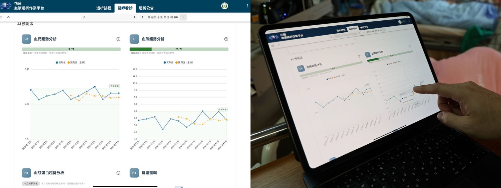 花蓮慈濟醫院今年也在血液透析作業平台中導入 AI 預測功能,協助醫護更早掌握病人狀況。