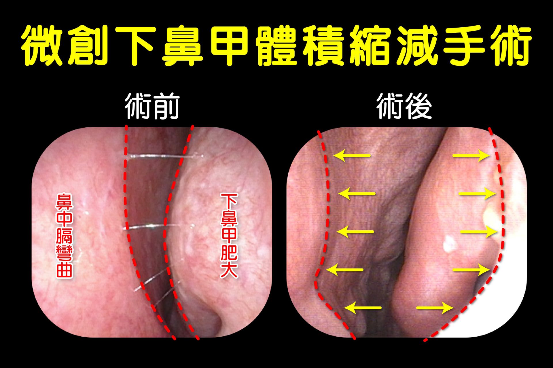 微創下鼻甲體積縮減手術術前術後對照圖。