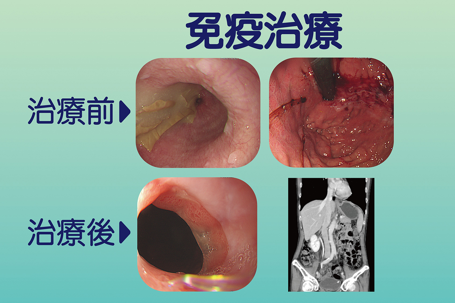 病人接受免疫治療前後比照,腫瘤明顯縮小,阻塞症狀得到緩解。
