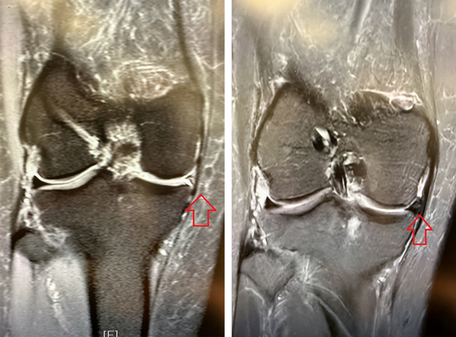 手術前,核磁造影檢查發現半月軟骨不見蹤跡(左);手術後半年,可見移植的半月軟骨(右)。