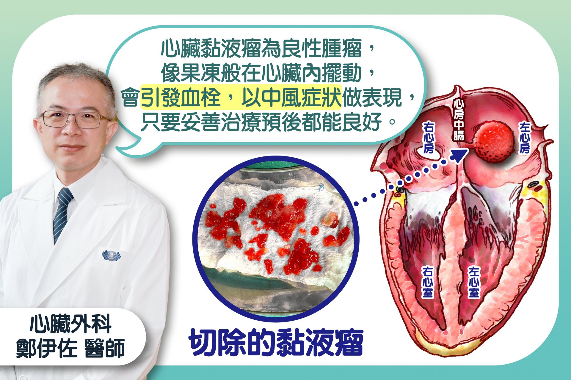 鄭伊佐醫師說明,心臟黏液瘤為良性腫瘤,像果凍般在心臟內擺動,會引發血栓,以中風症狀做表現,只要妥善治療預後都能良好。