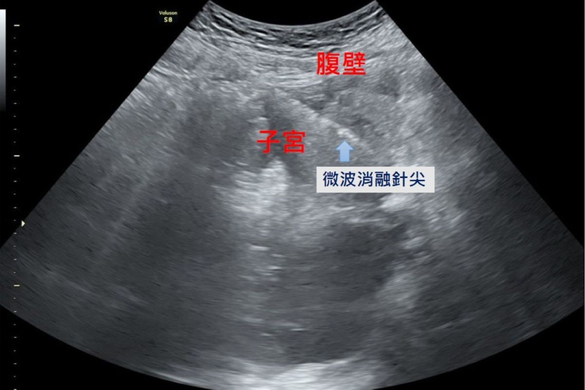 在腹腔鏡及婦科超音波的導引下,將消融針精準進入病灶,釋放高能量微波破壞異常內膜腺體組織,使其失去活性而逐漸縮小。