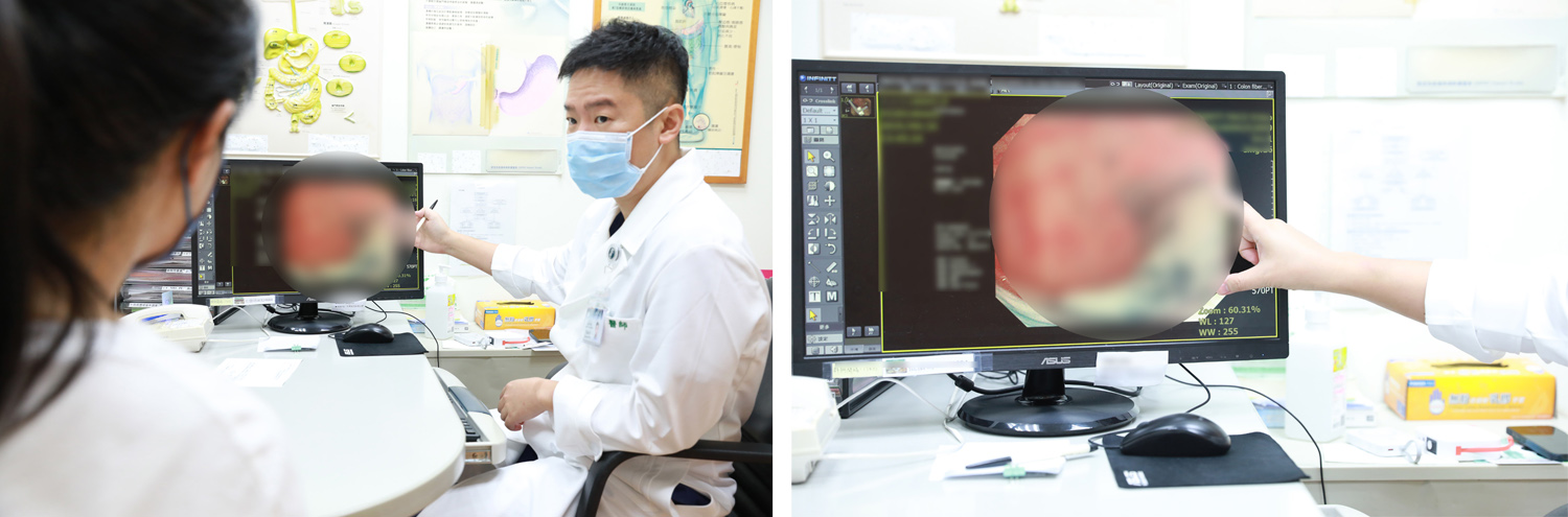 簡錫淵醫師仔細的為病人解說其大腸腫瘤位置與大小和治療方式。