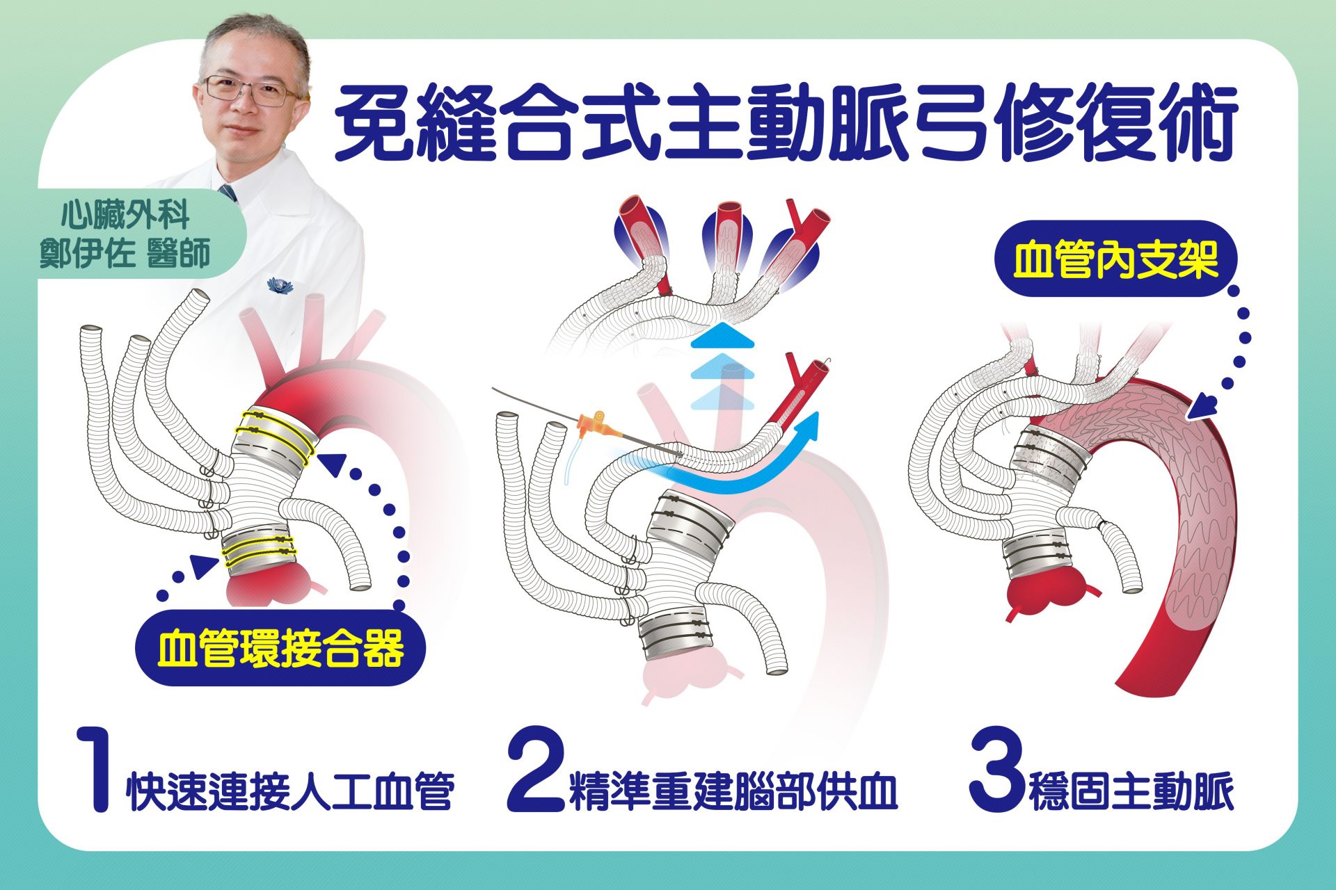 「免縫合式主動脈弓混合型手術」三步驟,讓急性主動脈剝離手術更快、更安全。