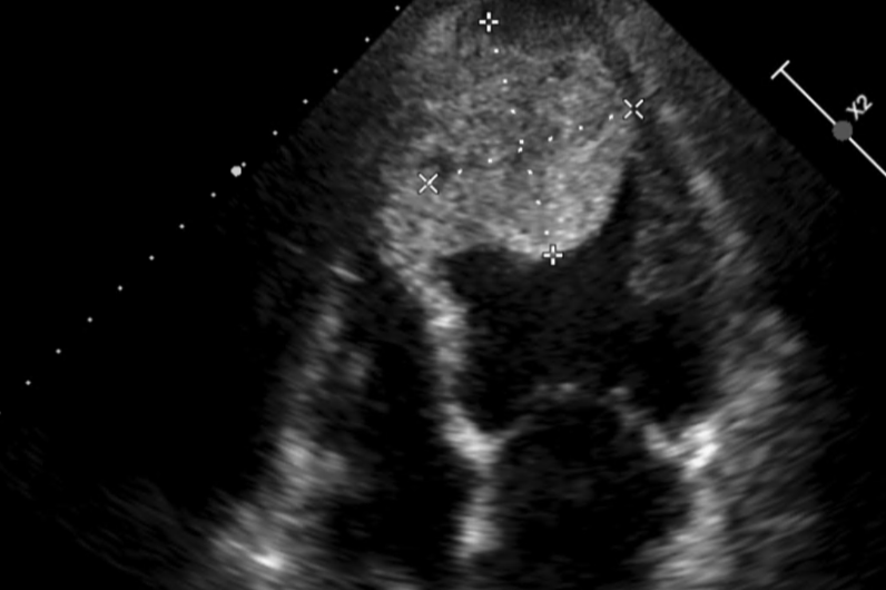 超音波檢查發現心臟有五公分大的血栓。