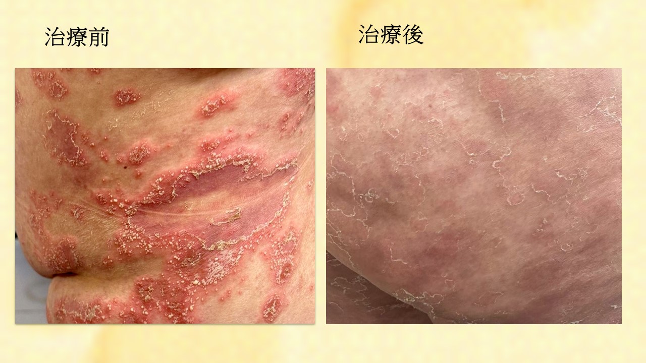 治療前後照片