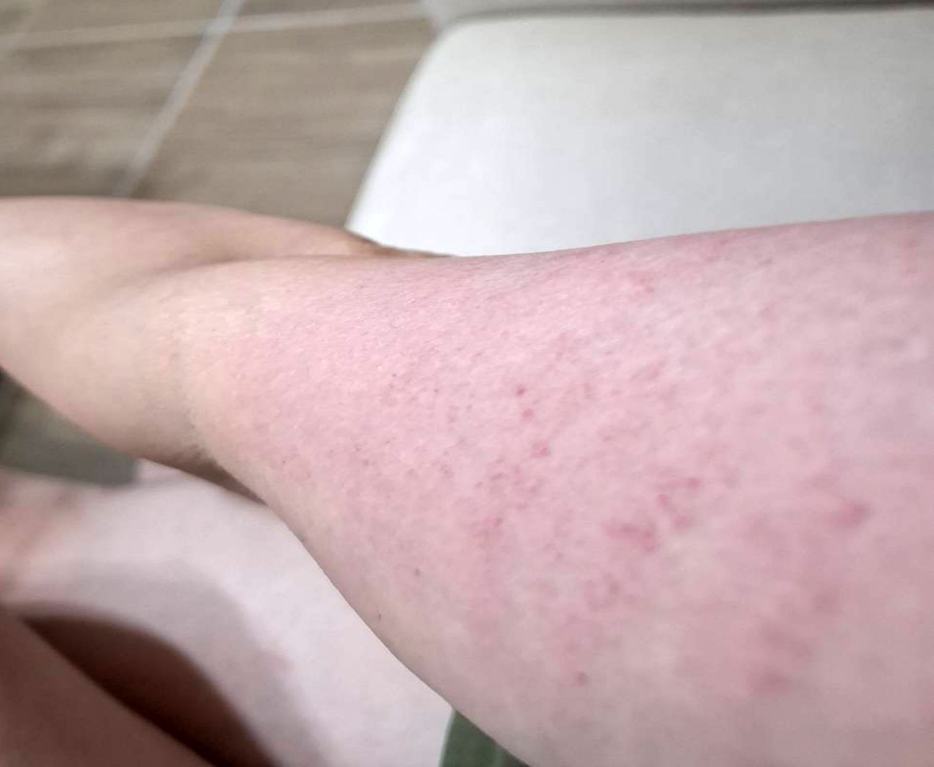 蔡姓女子皮膚癢的狀況。