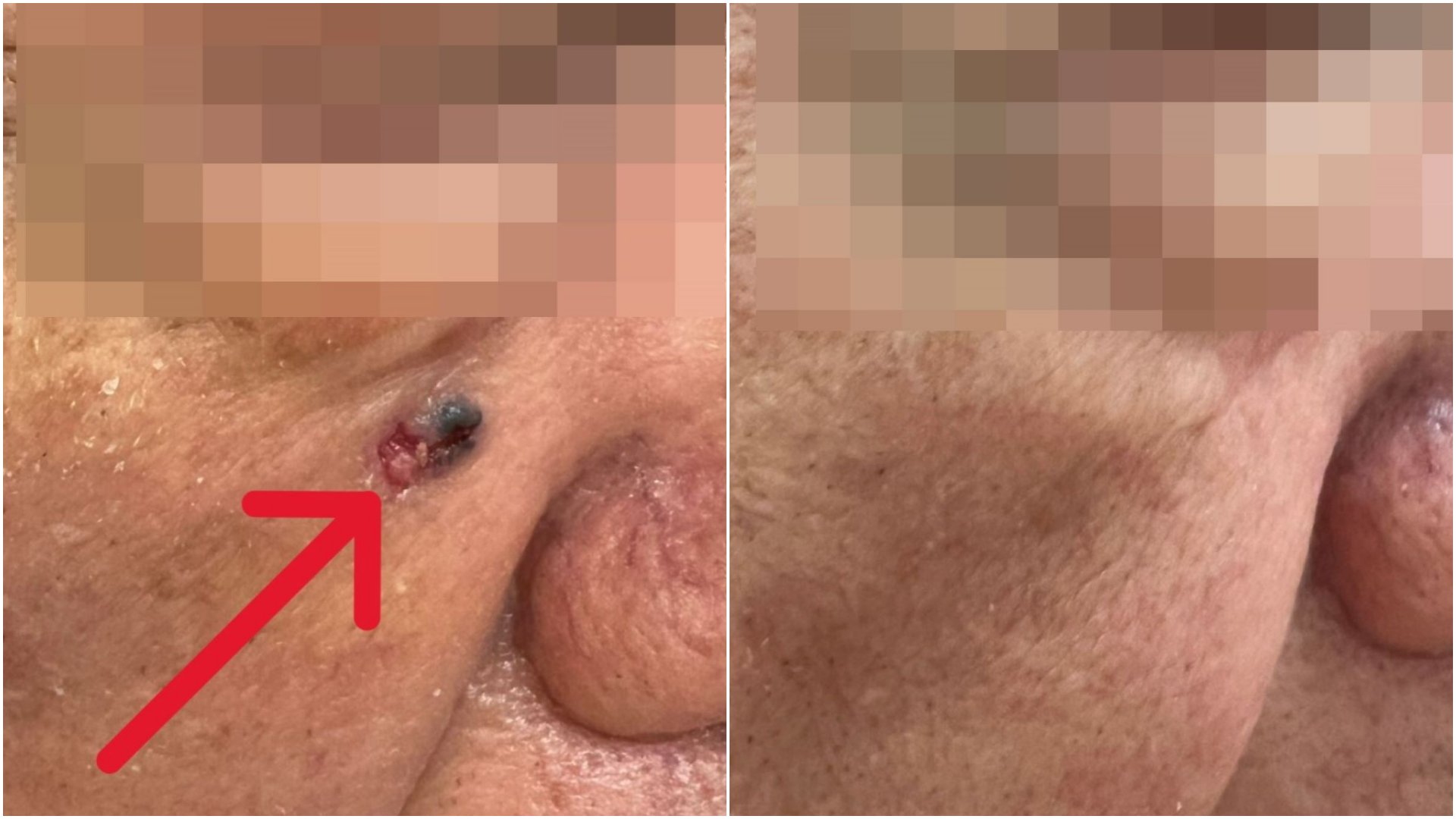 陳先生右臉出現黑色斑塊(左),切片檢驗確診為基底細胞癌,隨即接受皮膚腫瘤廣泛性切除手術,術後恢復良好(右),目前僅需做好日常防曬避免復發。