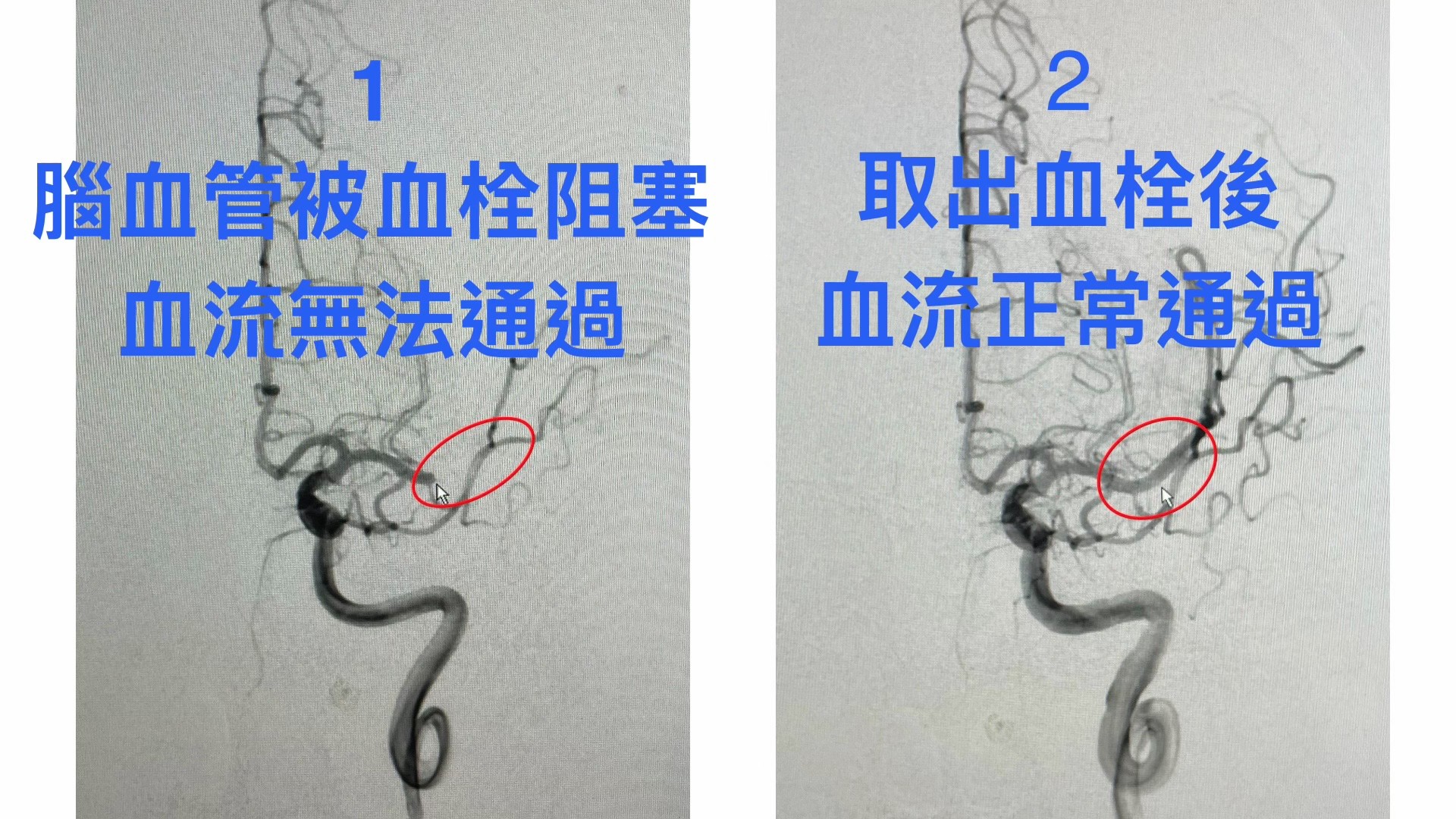 從血管攝影可以清楚看見原本腦血管被血栓阻塞時,血流完全無法通過(左),取栓成功後血流可以正常通過(右)。