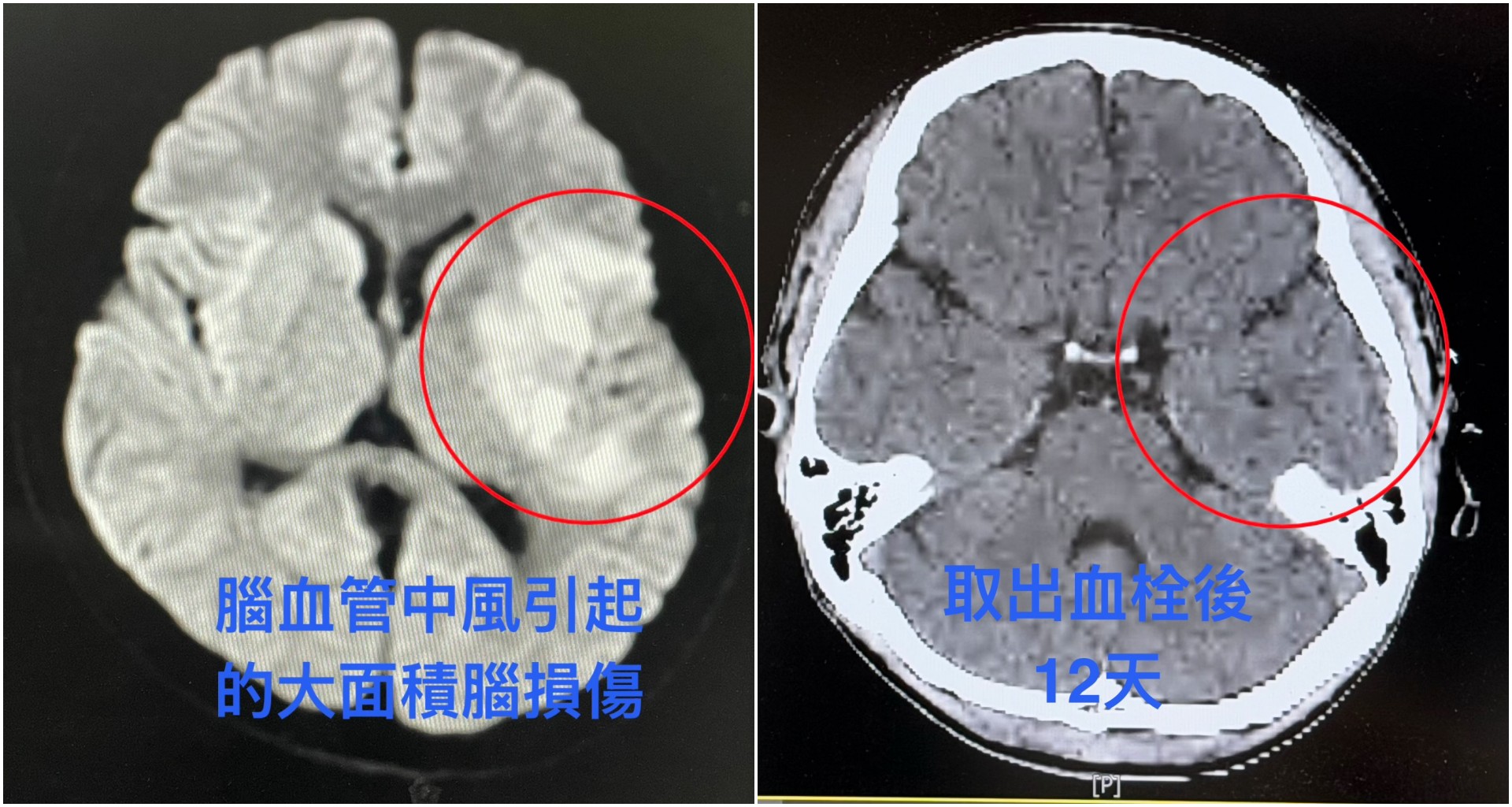 (左圖)從MRI(核磁共振)影像檢查中明顯看見,因為腦血管中風造成王先生左側腦組織大面積損傷。(右圖)術後的MRI檢查。