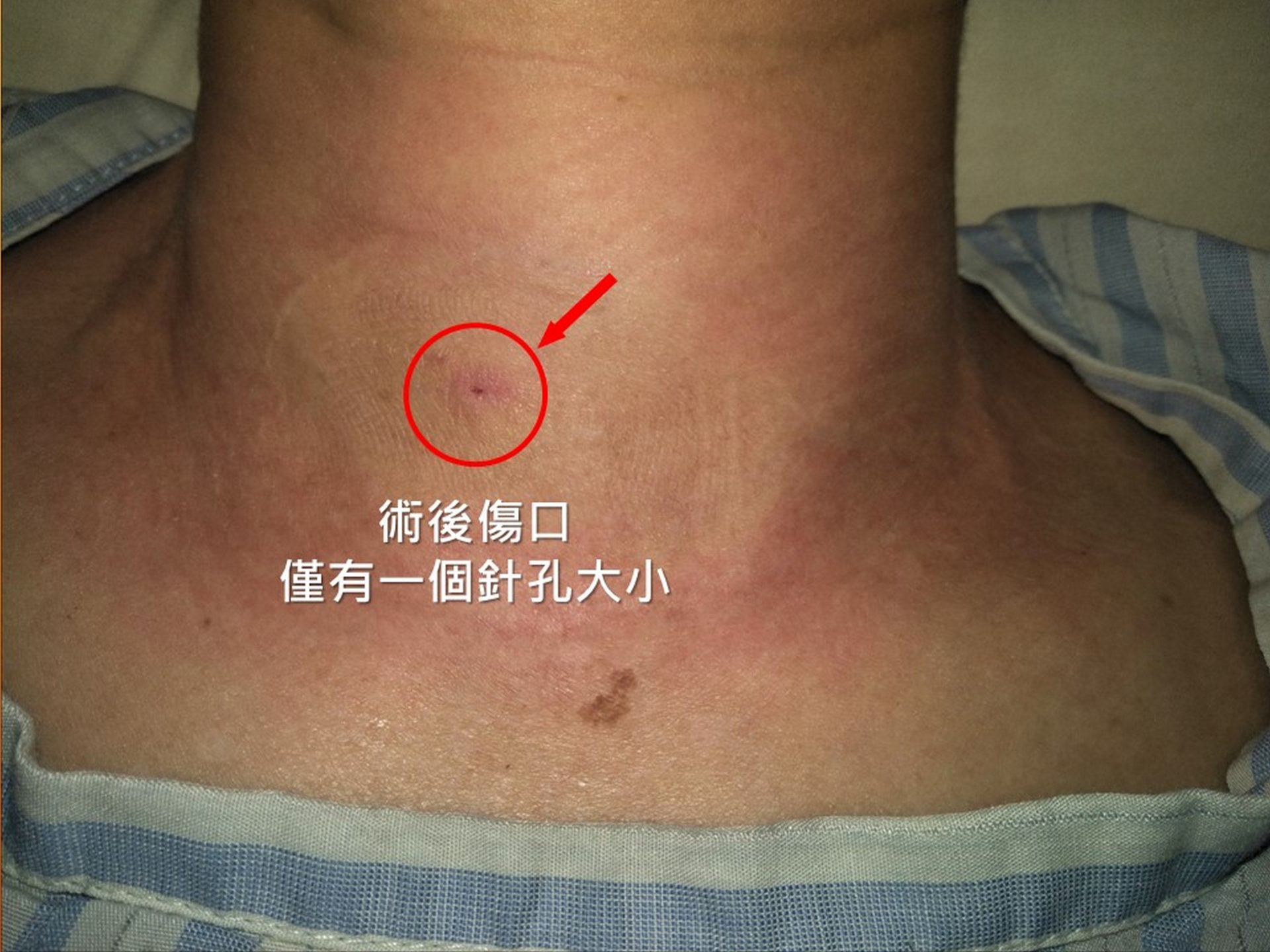 甲狀腺消融術後傷口僅一個針孔大小。